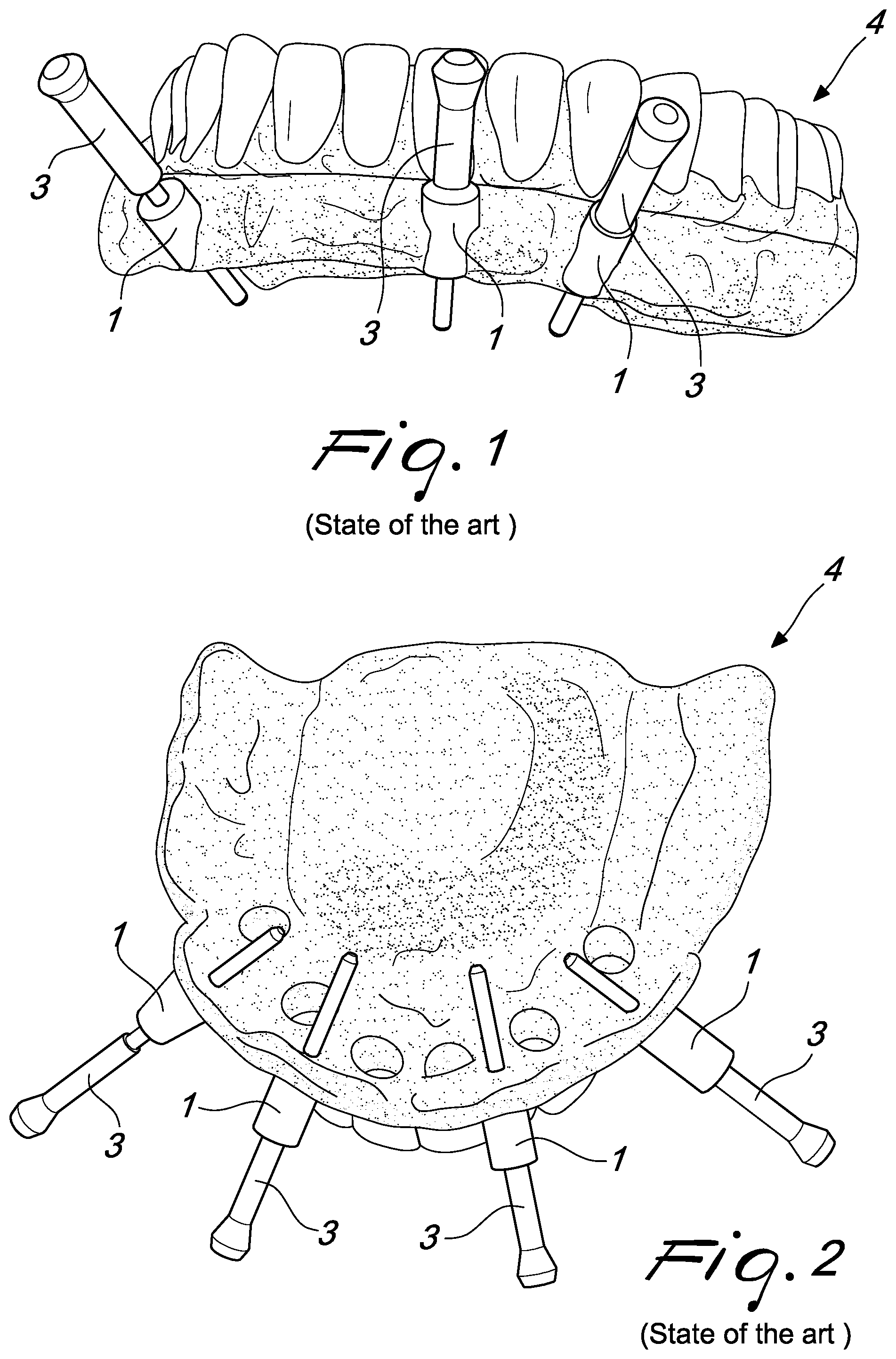 Patent US12097088 — Fixing pin support for dental prostheses and method of the manufacturing thereof — Figure 1