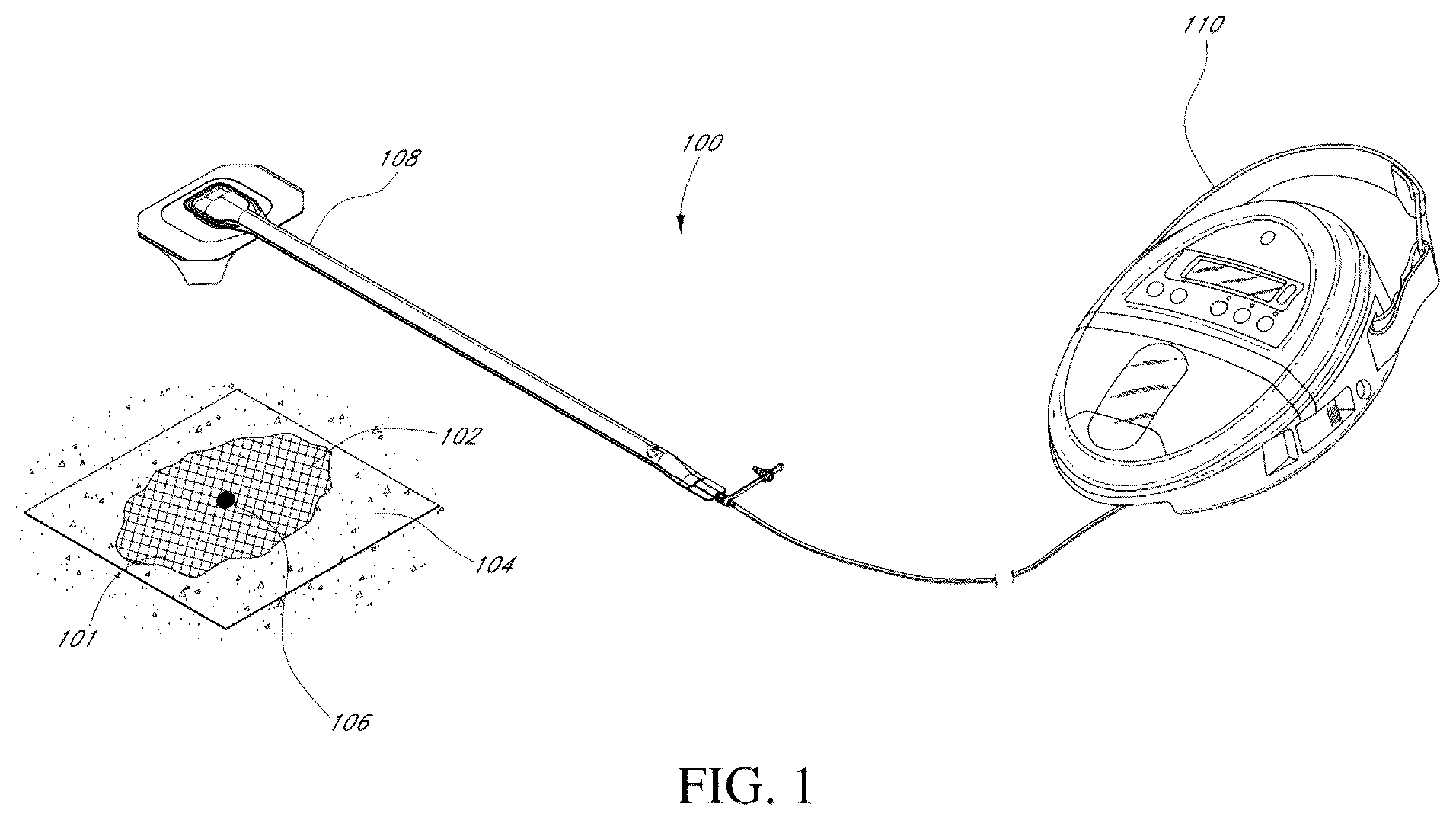 Patent US12097096 — Customizable wound closure device and method of use — Figure 1