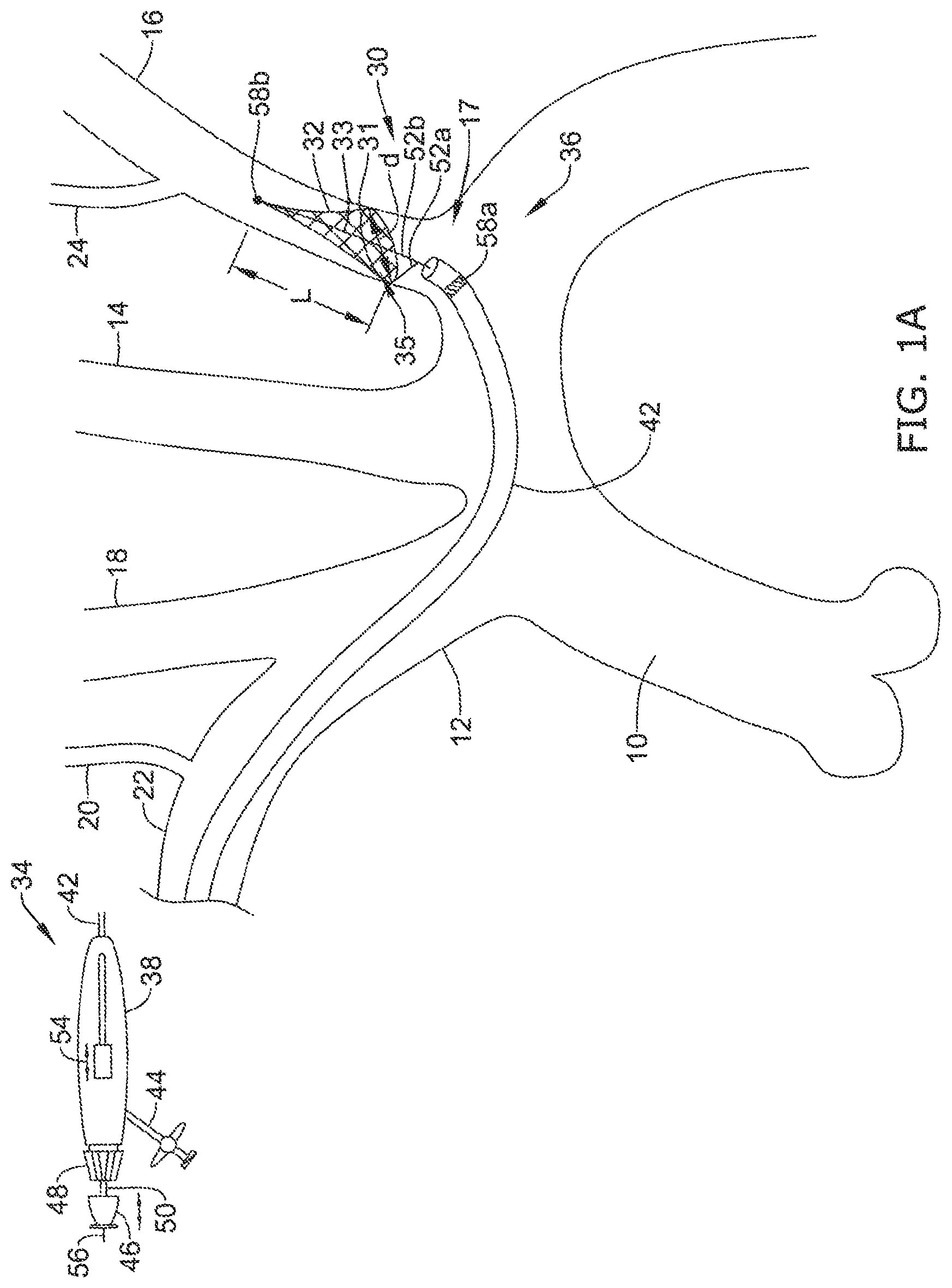 Patent US12097108 — Systems and methods for protecting the cerebral vasculature — Figure 1