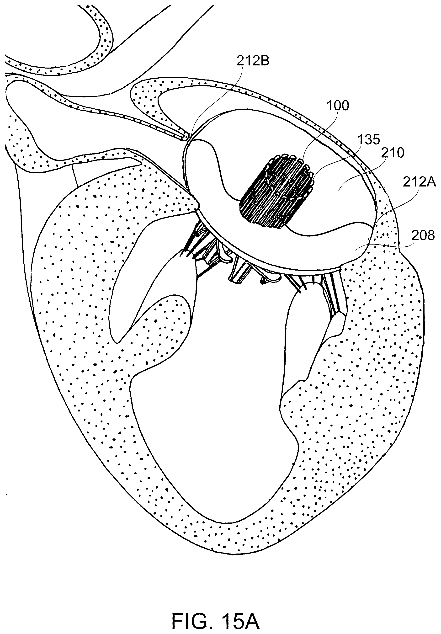 Patent US12097114 Figure 19 – Ventricular structure reshaping atrio-ventricular valve