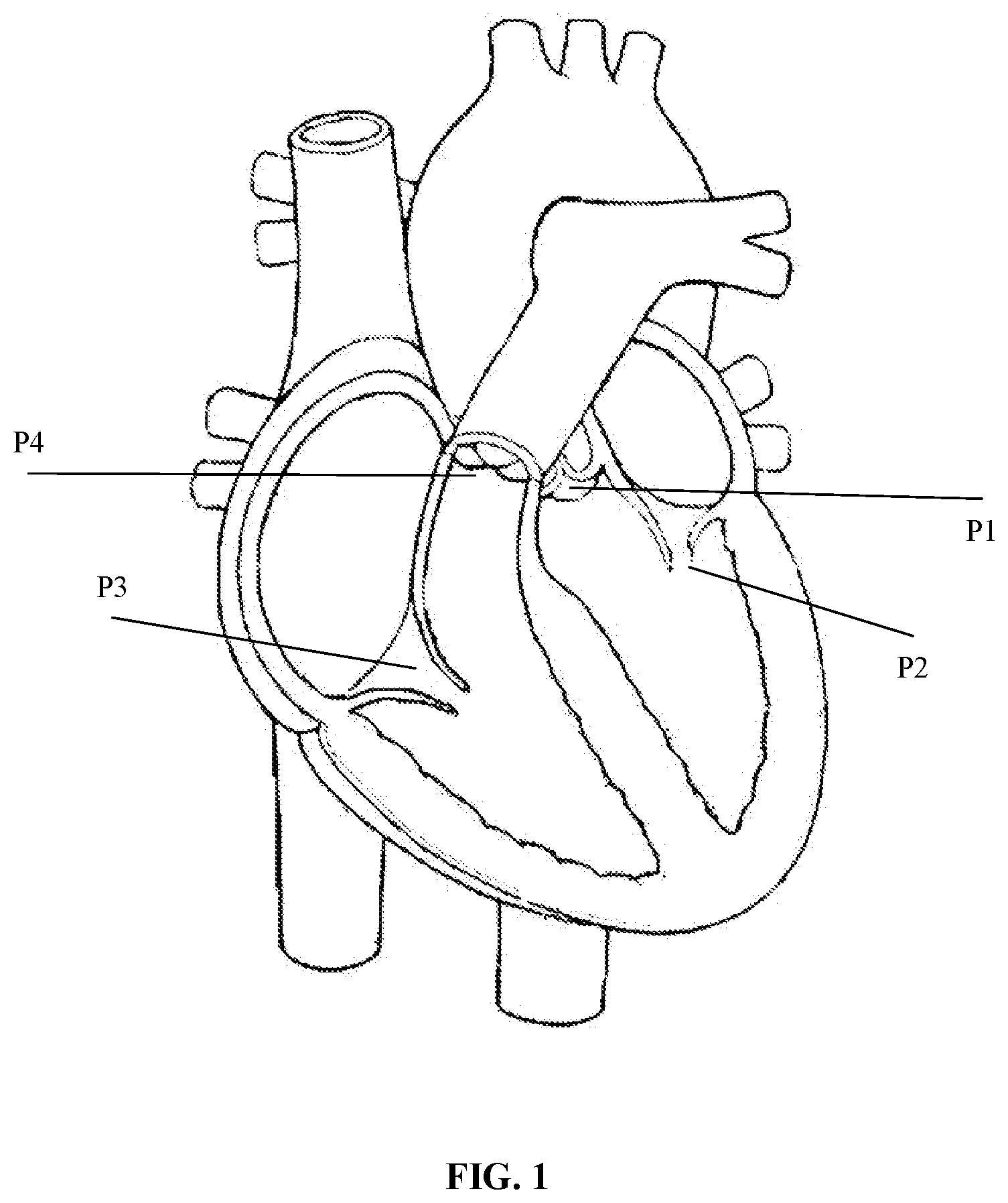 Patent US12097116 Figure 1 – Prosthetic heart valve for multiple positions and assembling method thereof