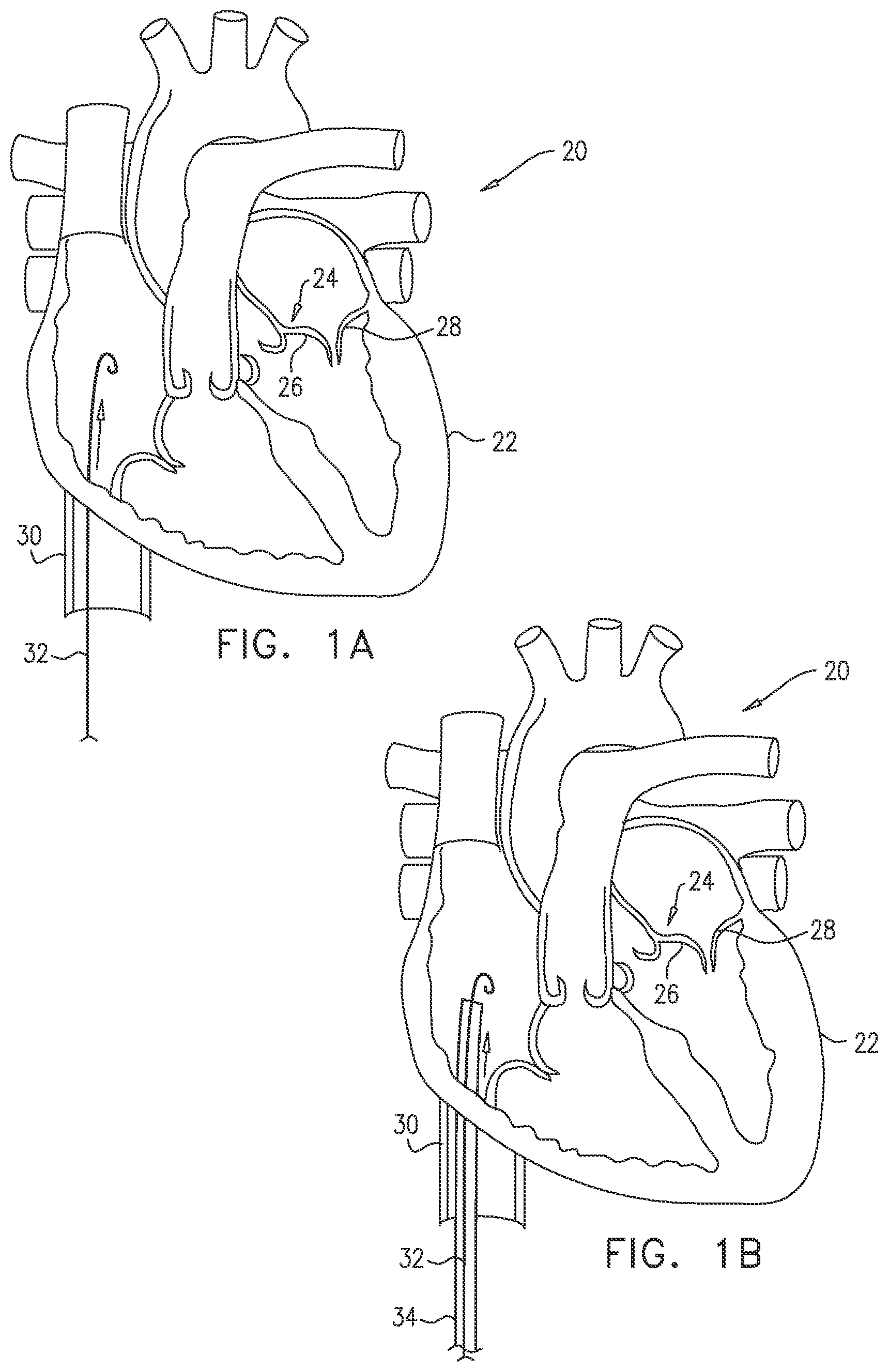 Patent US12097118 — Tissue anchor for heart implant — Figure 1