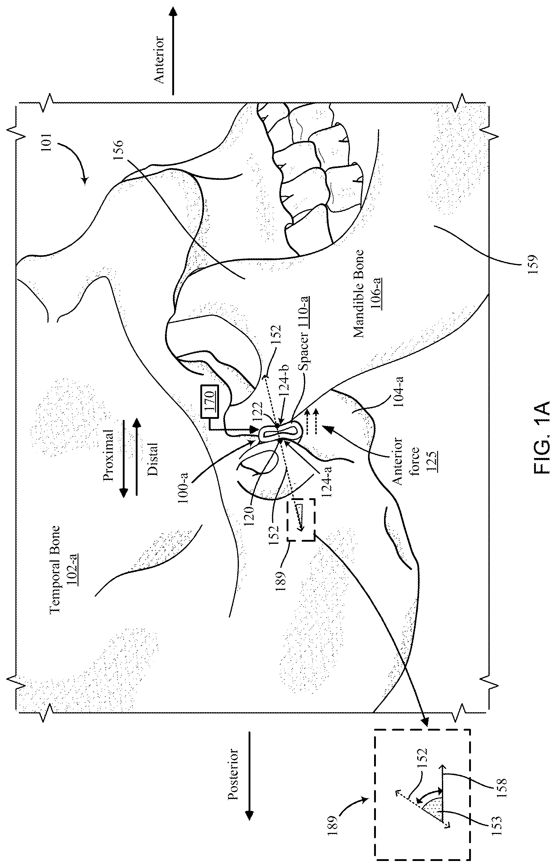 Patent US12097120 — Bone implant device — Figure 1