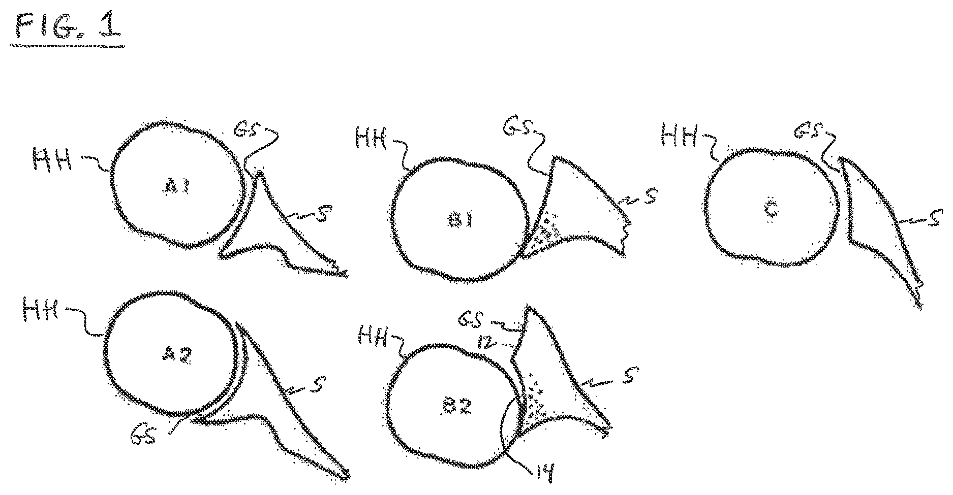 Patent US12097129 — Shoulder patient specific instrument — Figure 1
