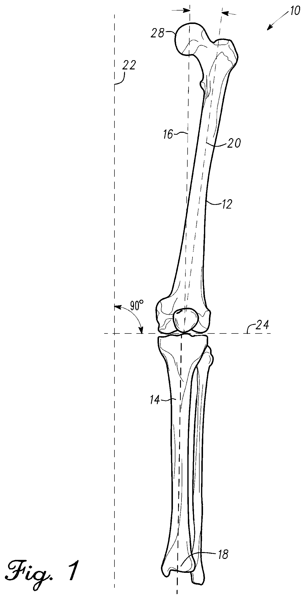 Patent US12097130 — Orthopedic leg alignment system and method — Figure 1