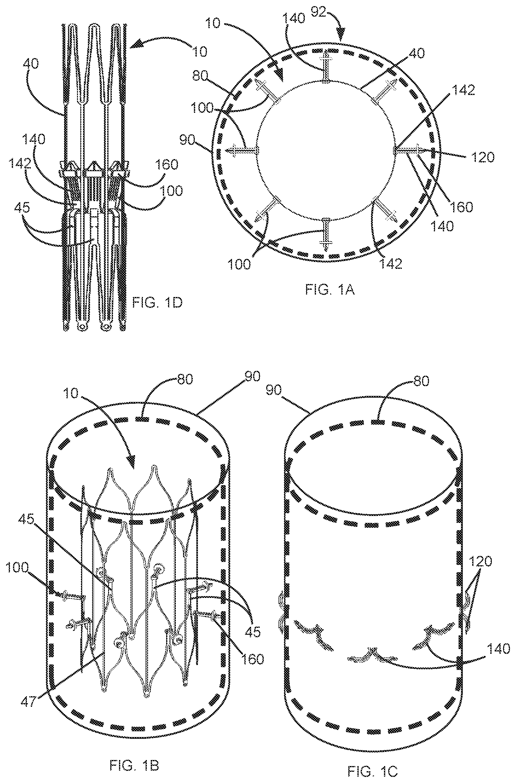 Patent US12097136 — Graft securing system, applicator and method — Figure 1