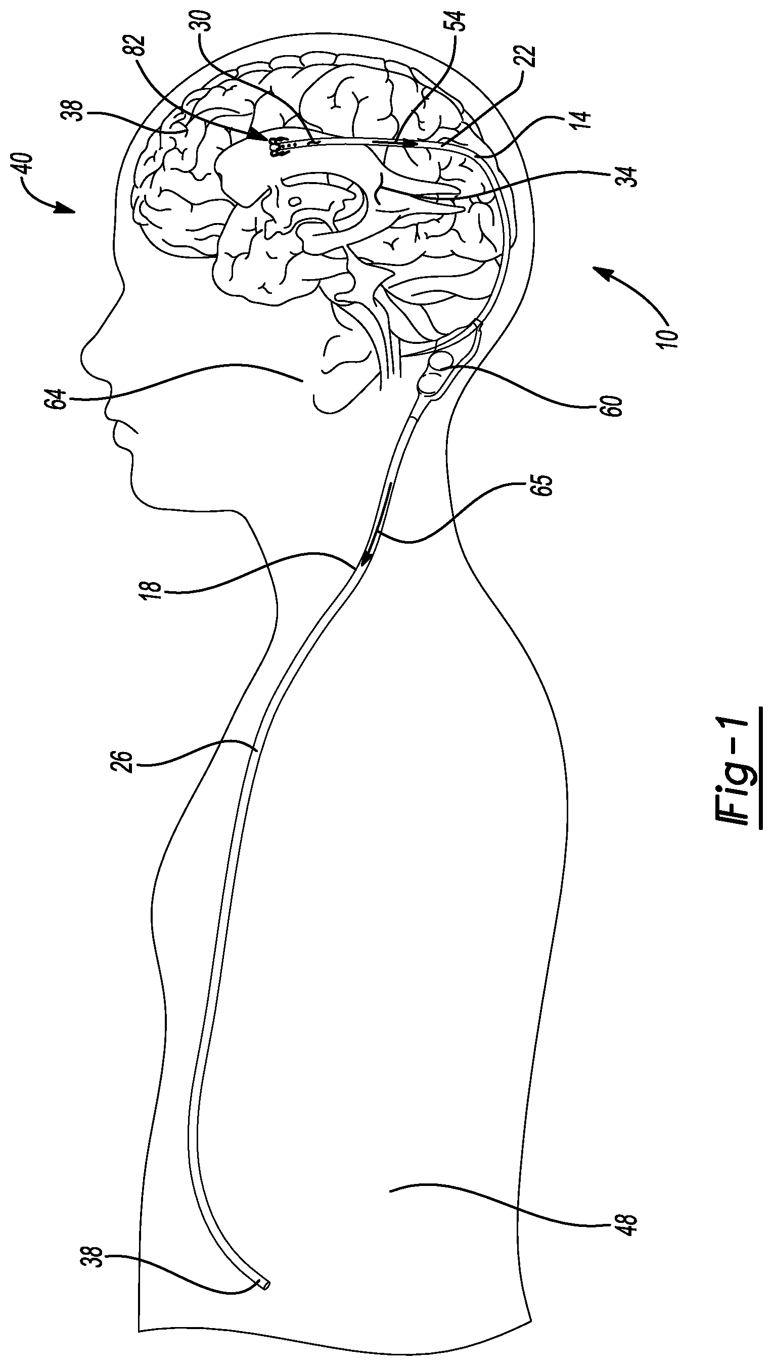 Patent US12097347 — System and method for a shunt — Figure 1