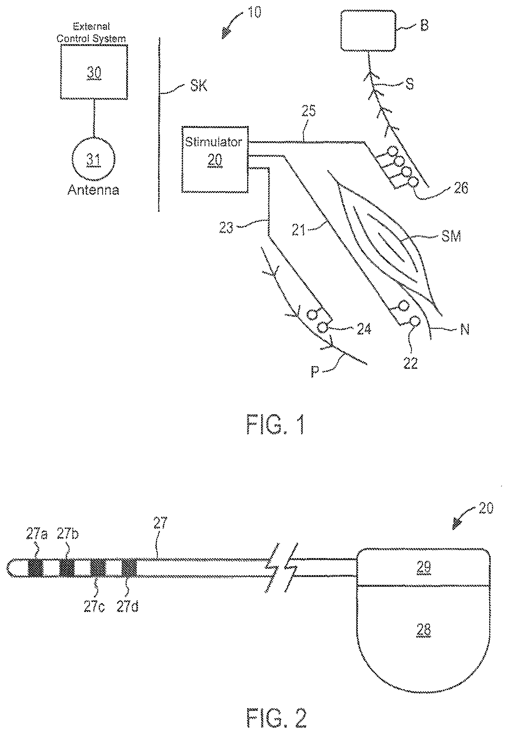 Patent US12097365 — Electrical stimulator for the treatment of back pain and methods of use — Figure 1
