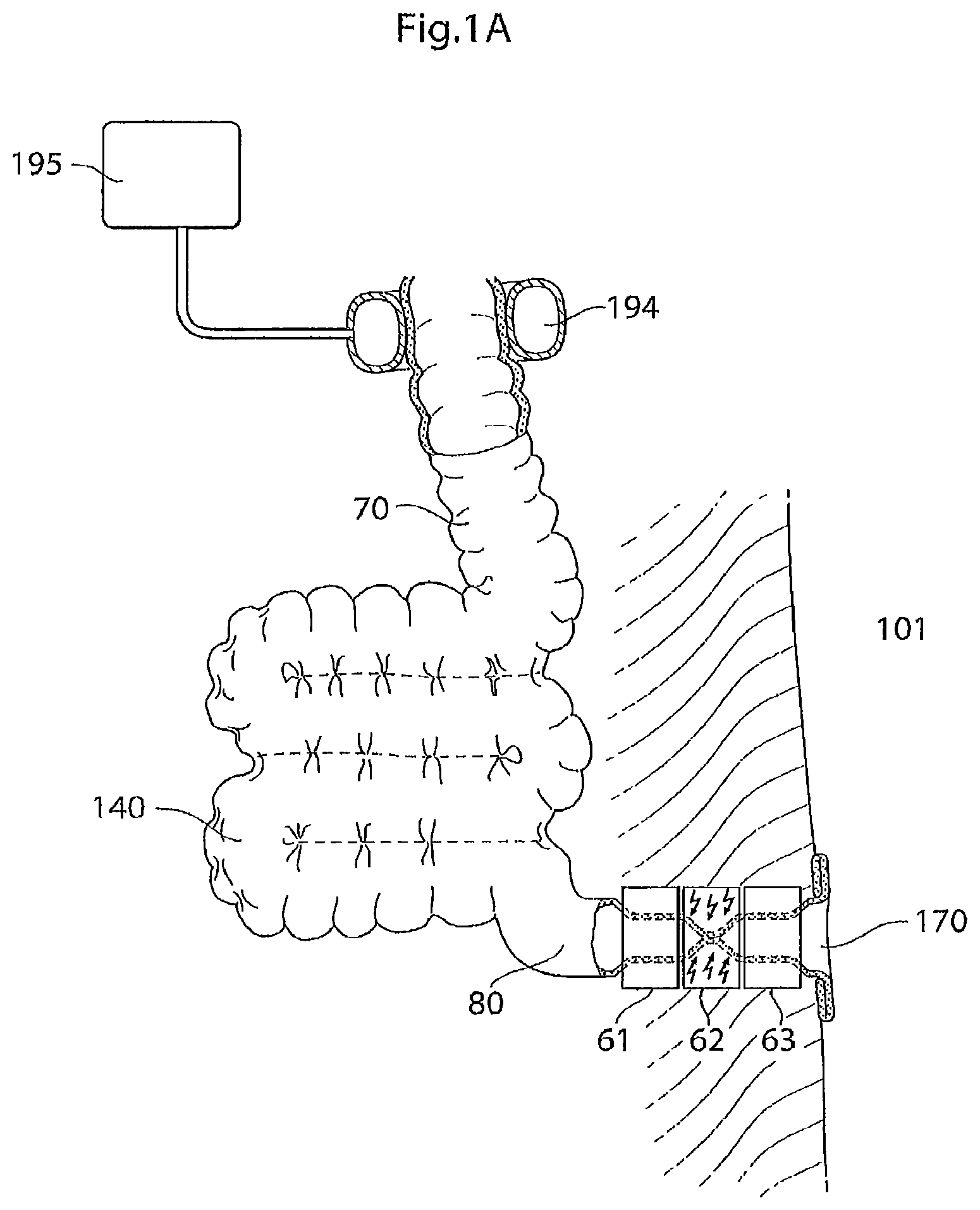 Patent US12097368 — System for treating a patient having an intestinal disorder — Figure 1