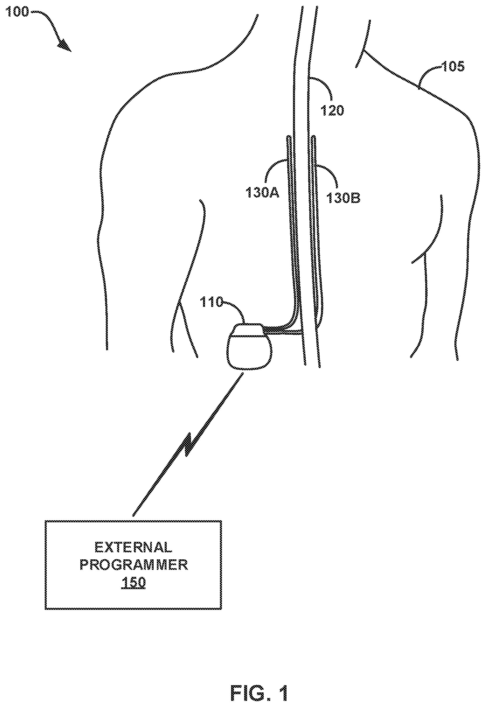 Patent US12097373 Figure 1 – Control policy settings for electrical stimulation therapy