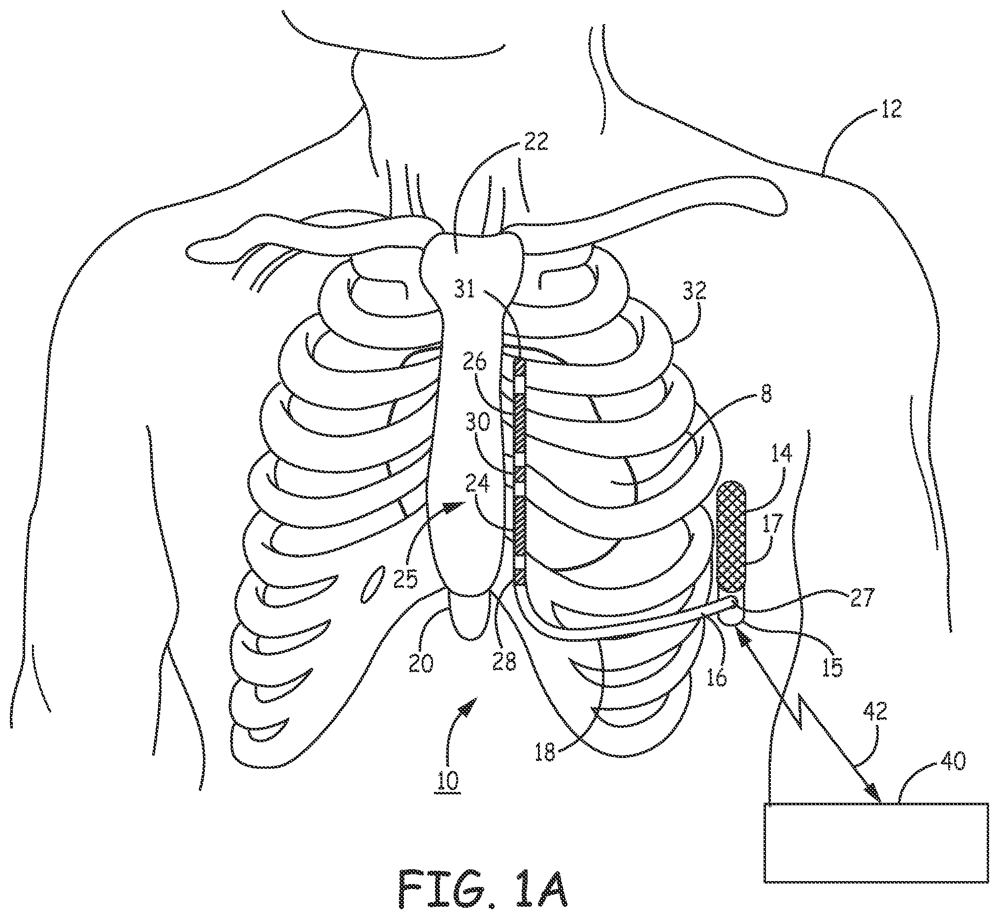 Patent US12097377 — Asystole detection and response in an implantable cardioverter defibrillator — Figure 1