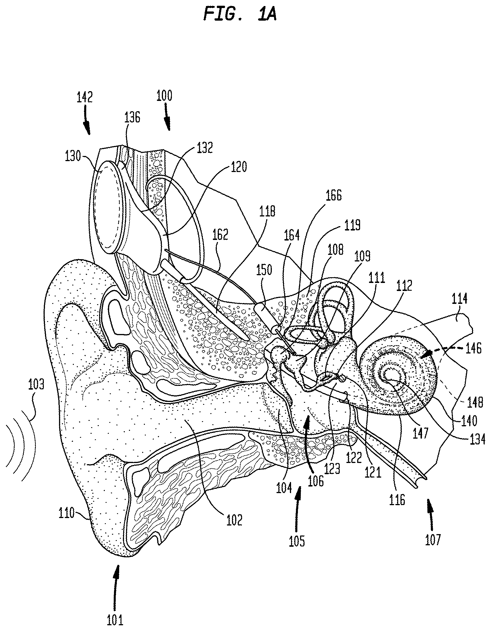Patent US12101602 — Implantable sound sensors with non-uniform diaphragms — Figure 1