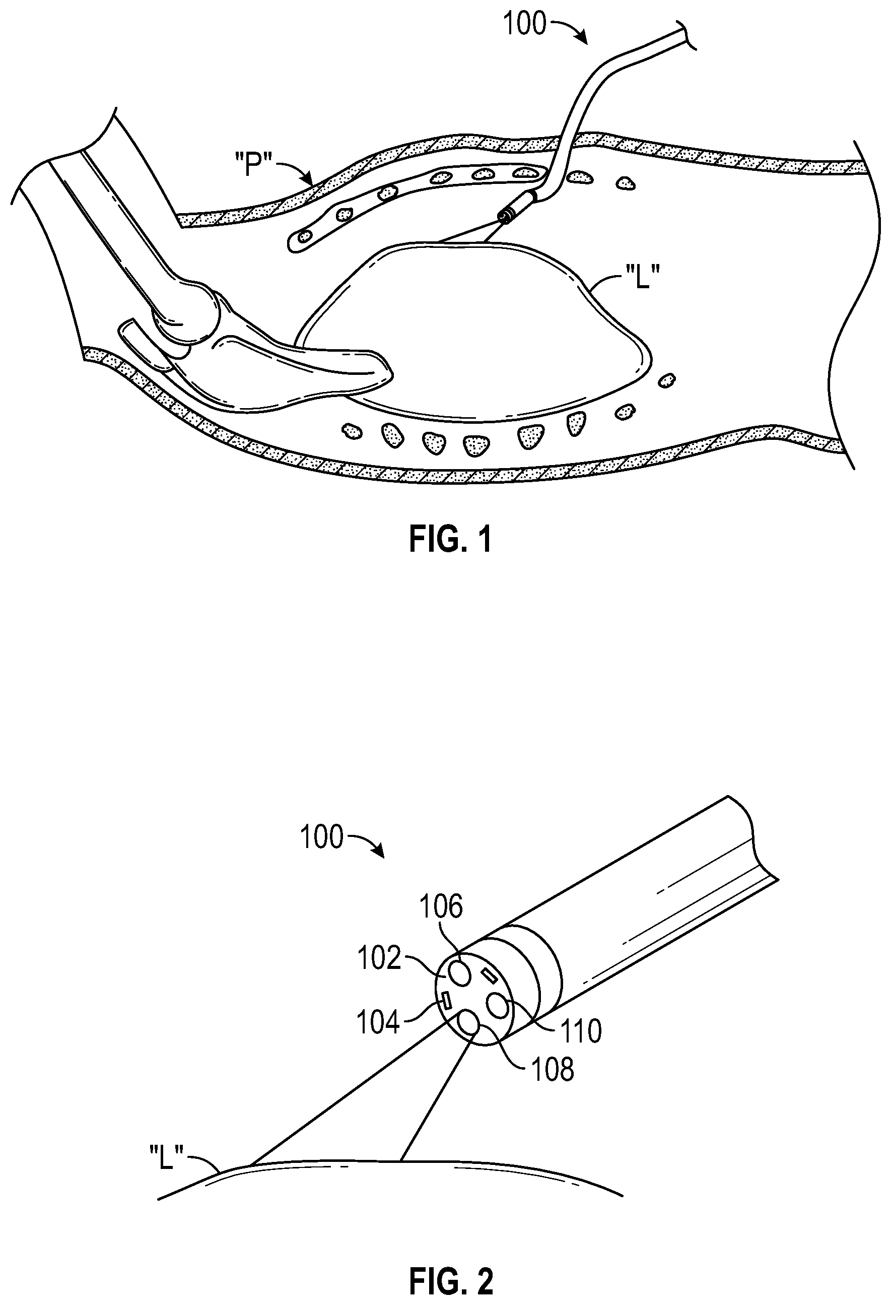 Patent US12102298 — Lymphatic system tracking — Figure 1