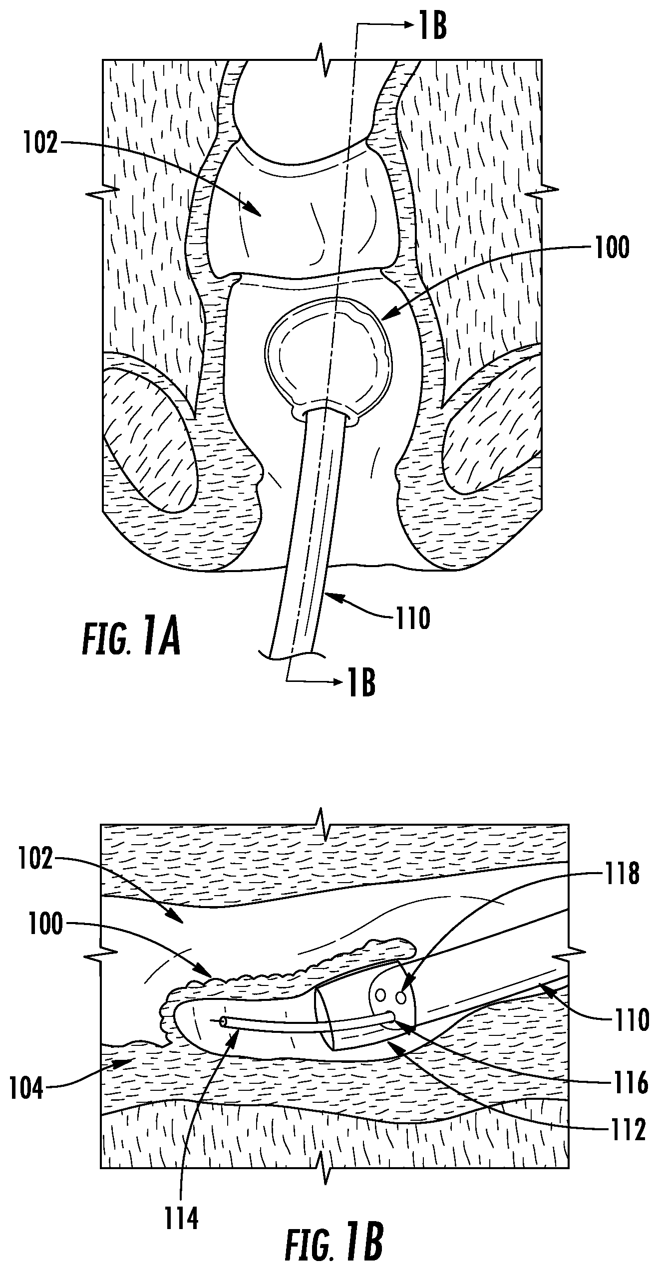 Patent US12102312 — Expandable devices, systems, and methods — Figure 1
