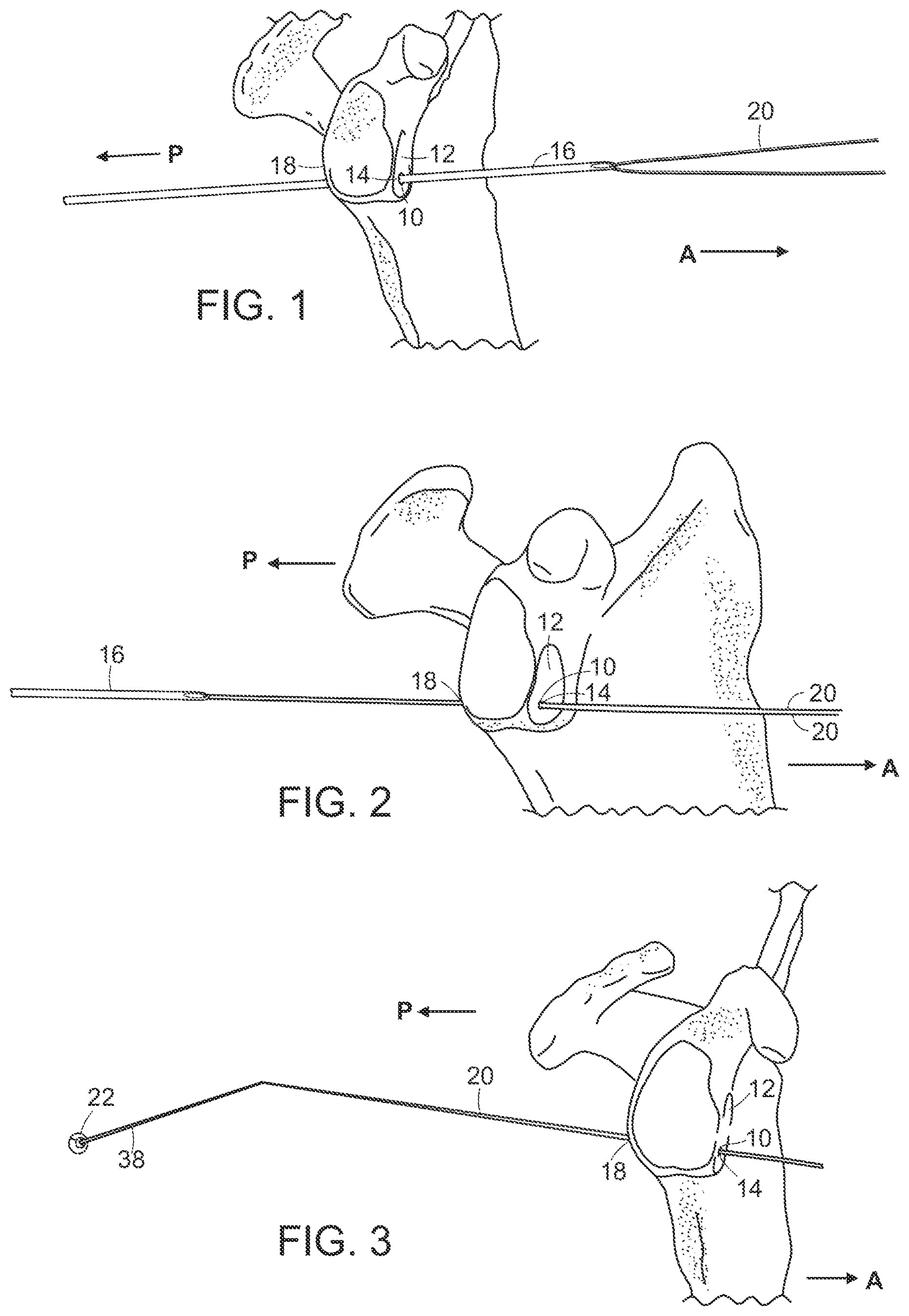 Patent US12102315 — Methods for passing a posterior button suture for medical procedures — Figure 1