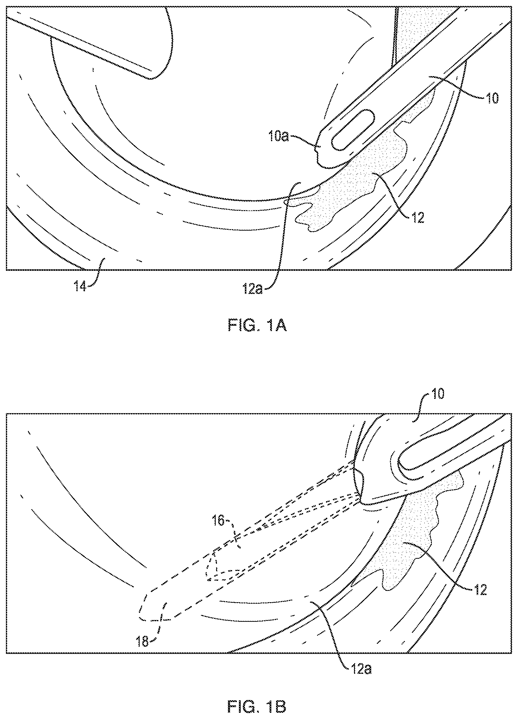 Patent US12102319 — Methods for measuring tissue defects — Figure 1