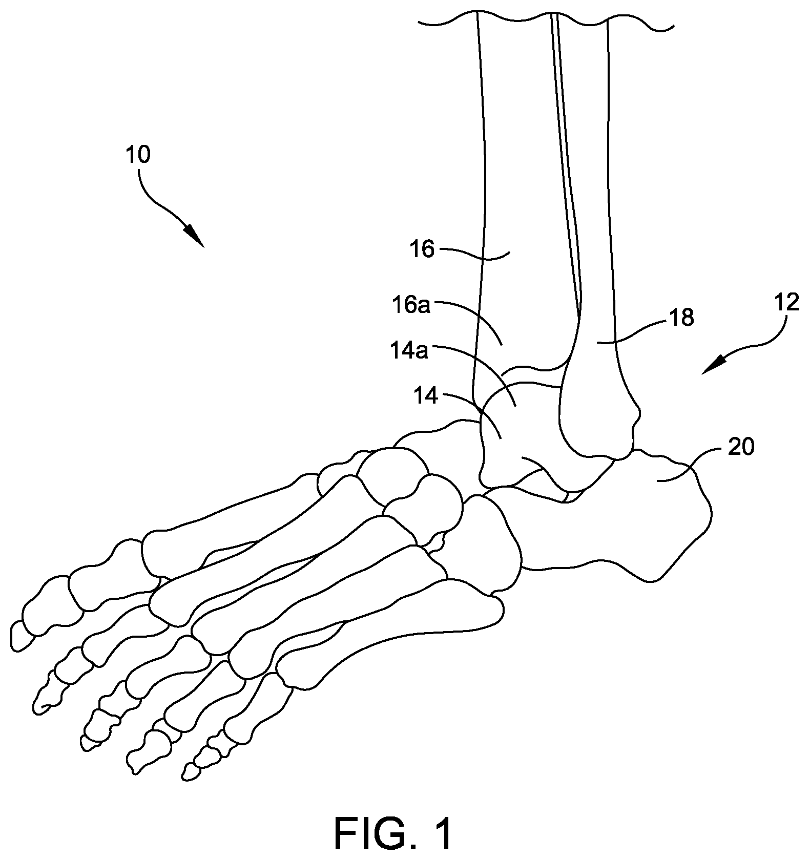Patent US12102339 Figure 1 – Instrument for intra-operative implant templating using fluoroscopy