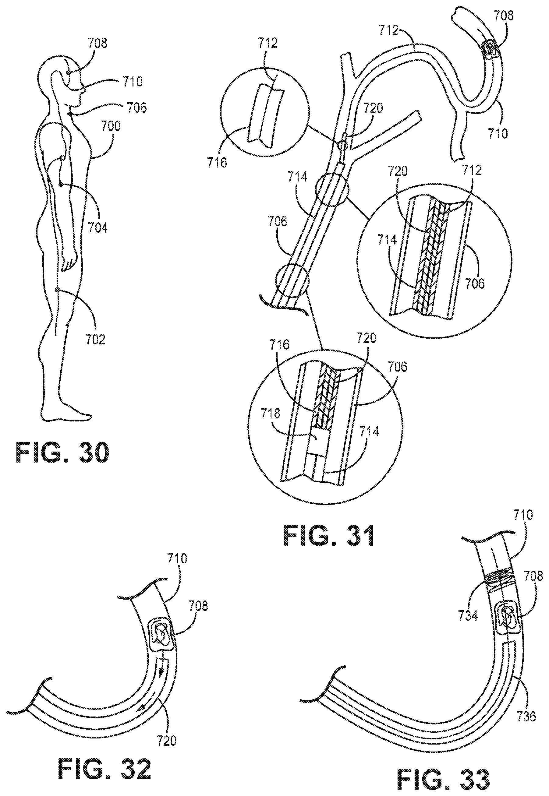 Patent US12102341 Figure 10 – Suction catheter systems for applying effective aspiration in remote vessels, especially cerebral arteries