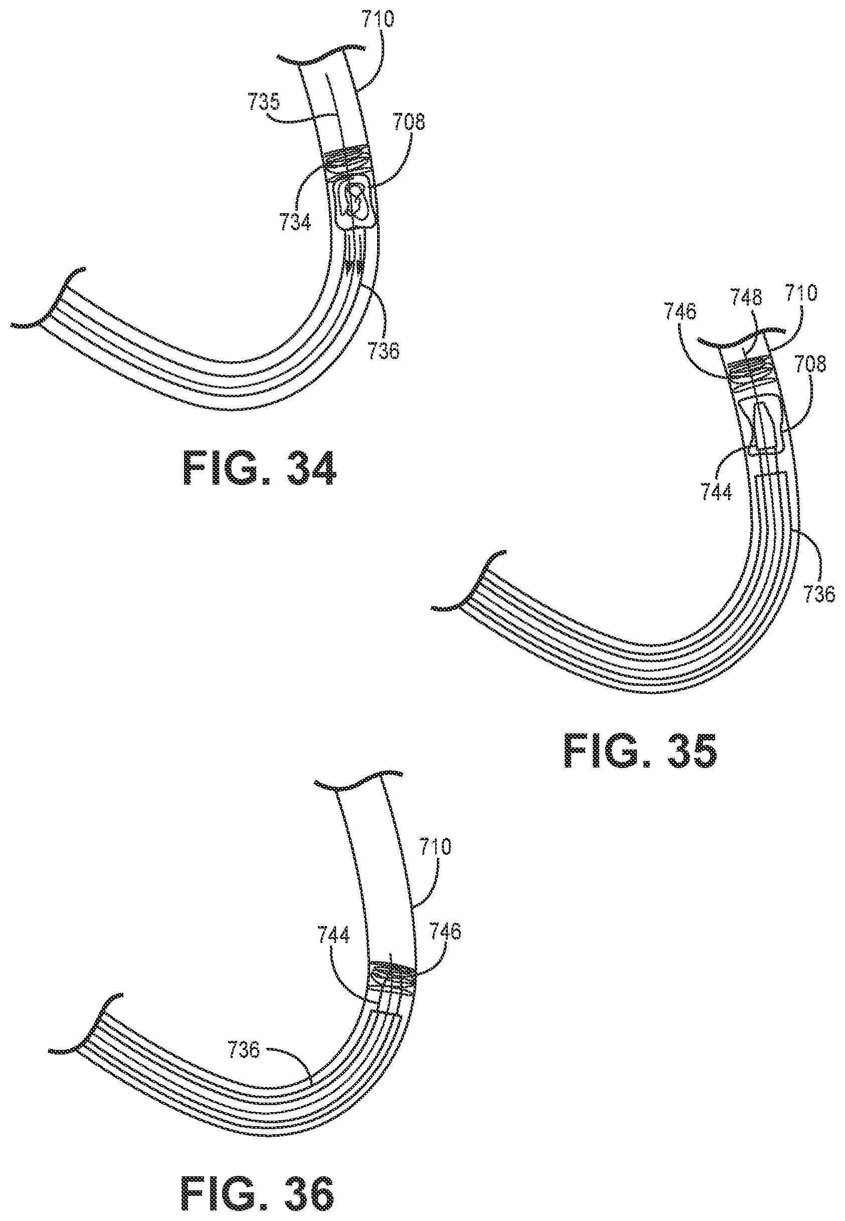 Patent US12102341 Figure 11 – Suction catheter systems for applying effective aspiration in remote vessels, especially cerebral arteries