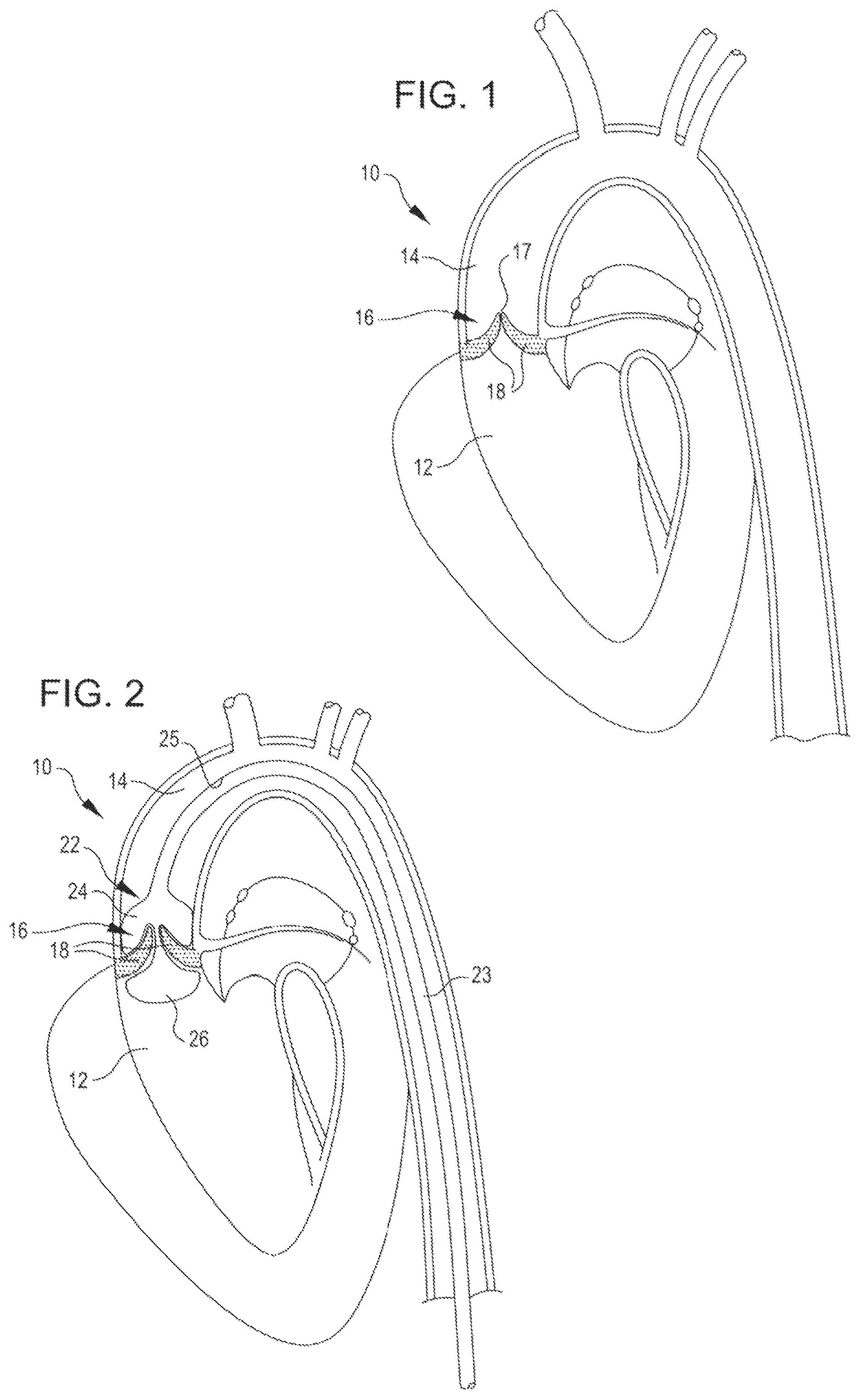 Patent US12102342 Figure 1 – Shockwave valvuloplasty catheter system