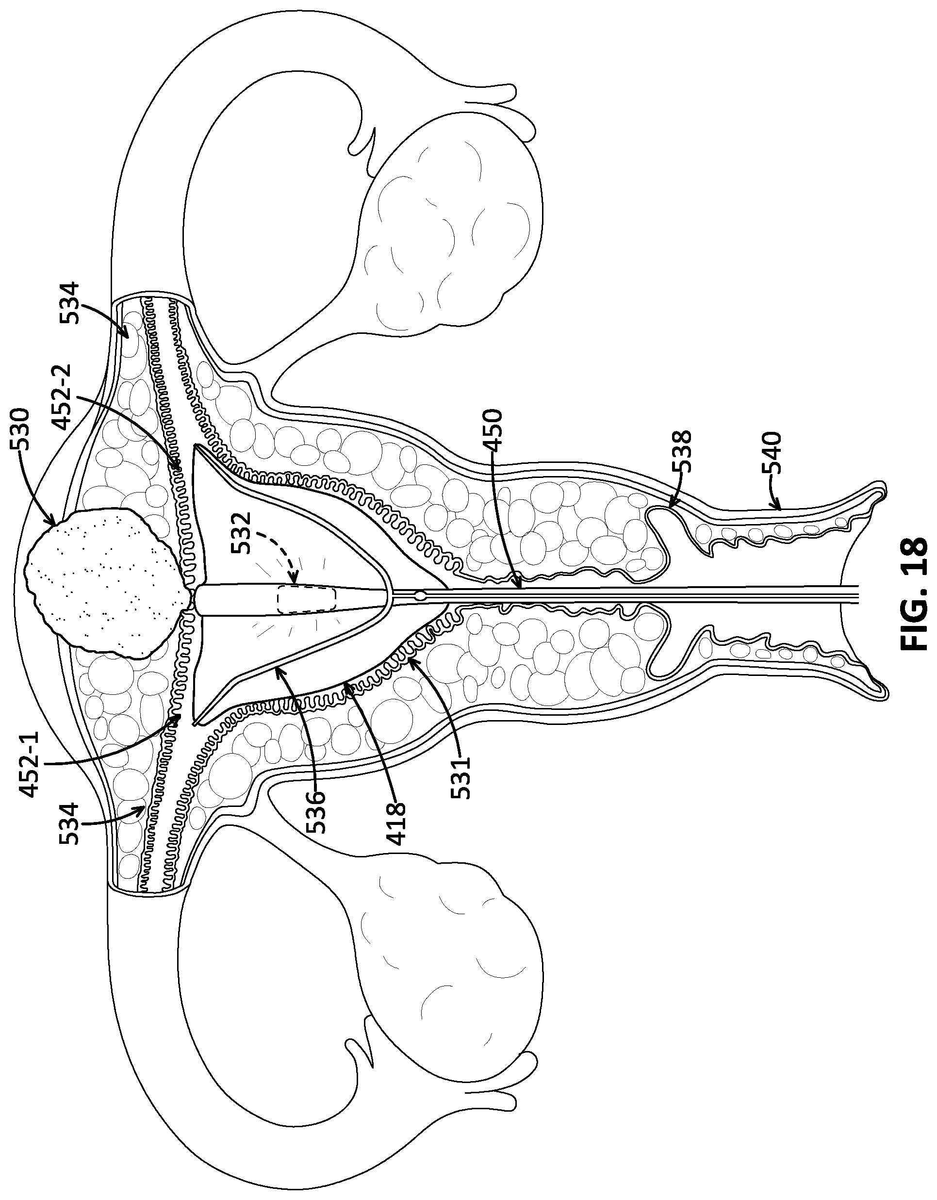 Patent US12102355 Figure 16 – Uterine manipulator with cutting head