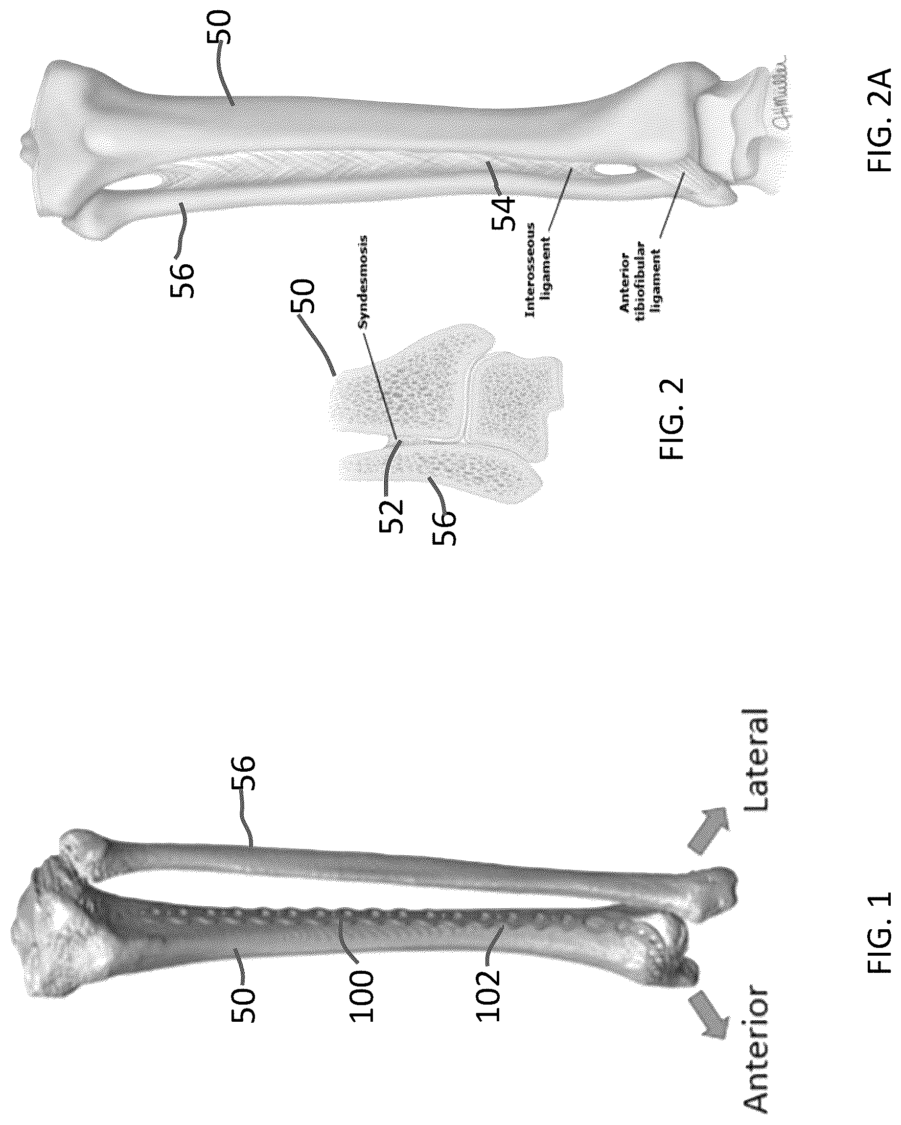 Patent US12102363 Figure 1 – Distal tibial plating system