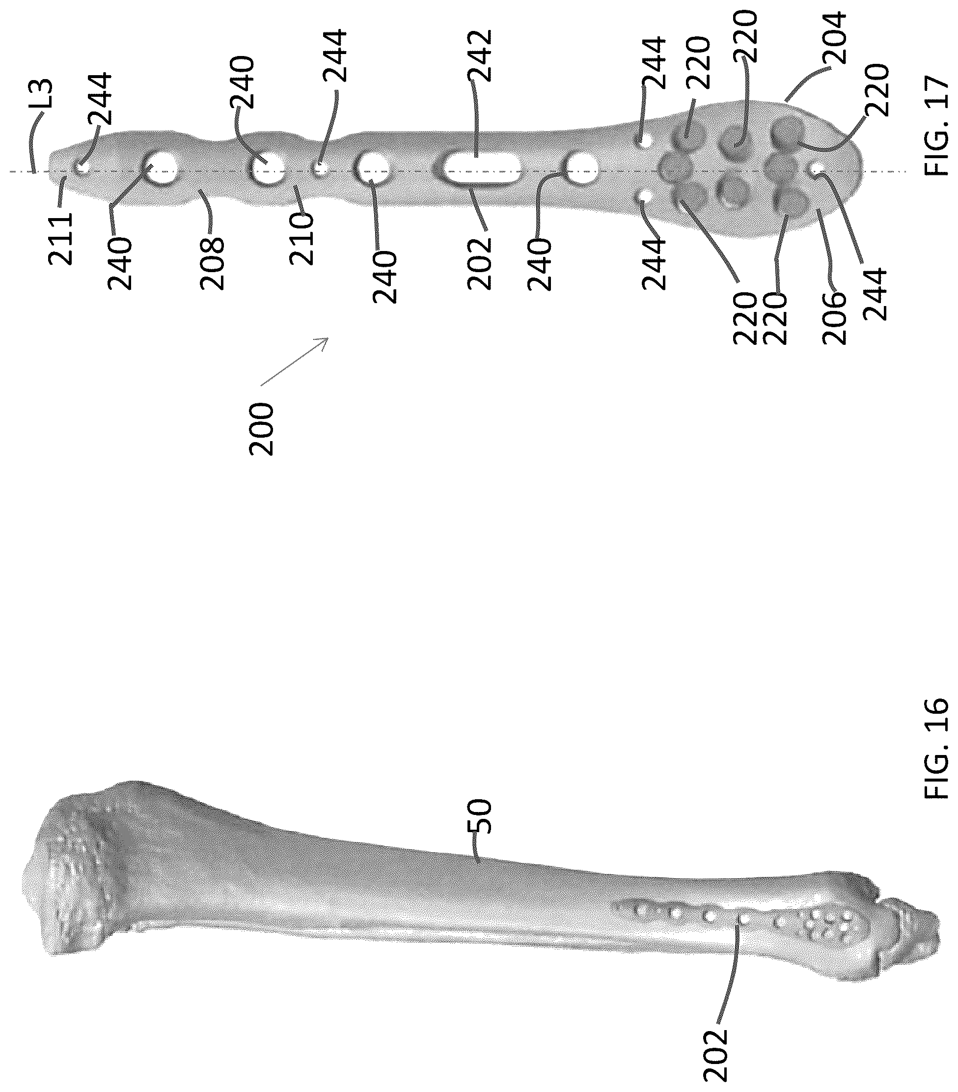 Patent US12102363 Figure 7 – Distal tibial plating system