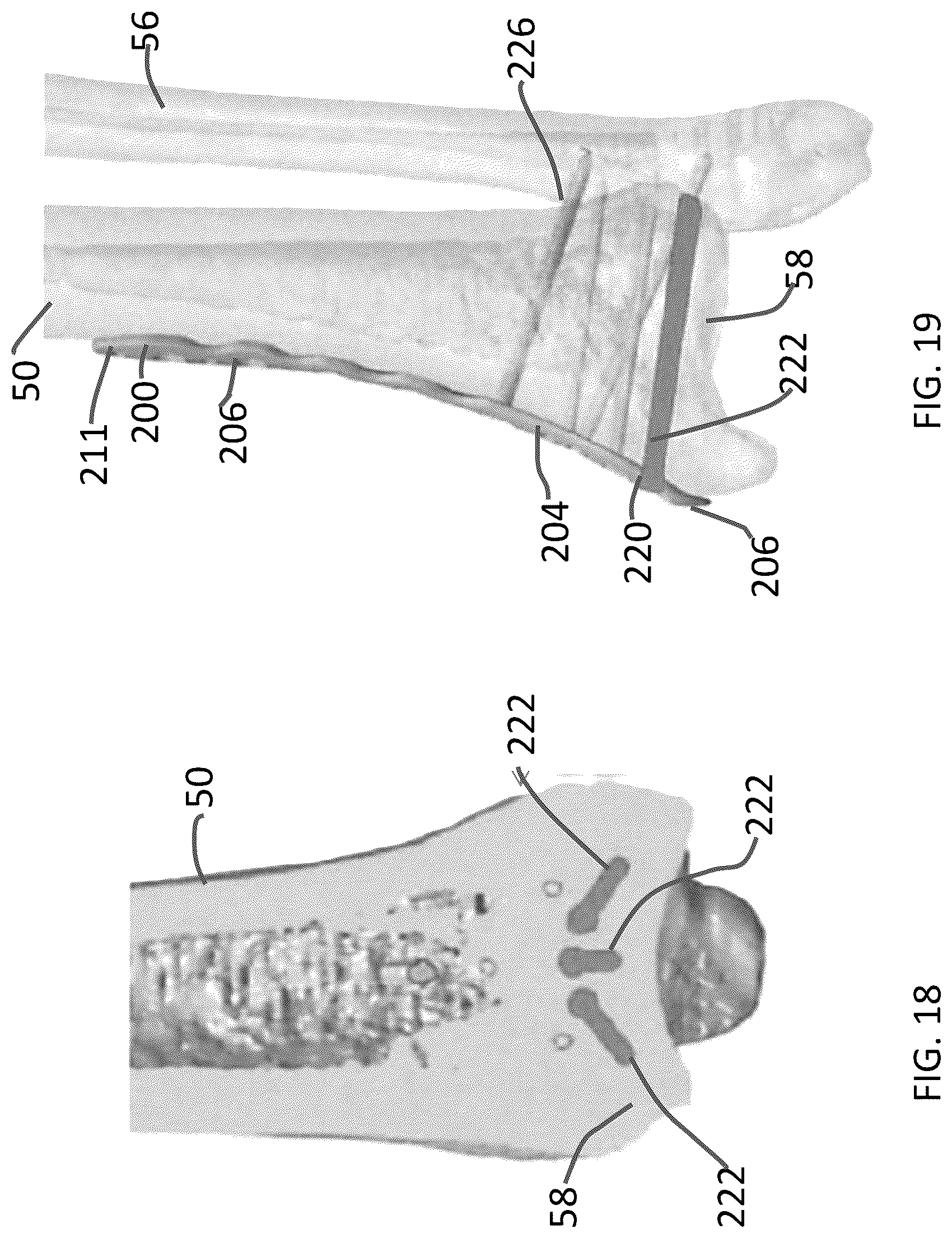 Patent US12102363 Figure 8 – Distal tibial plating system
