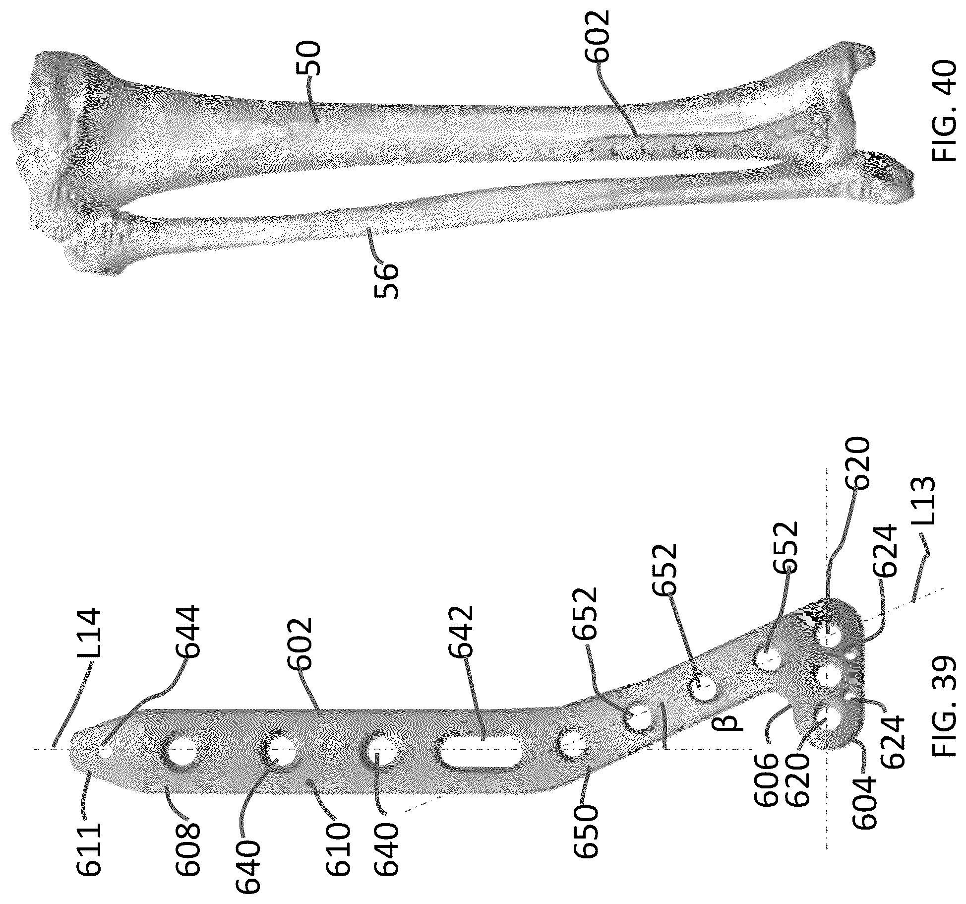 Patent US12102363 Figure 19 – Distal tibial plating system