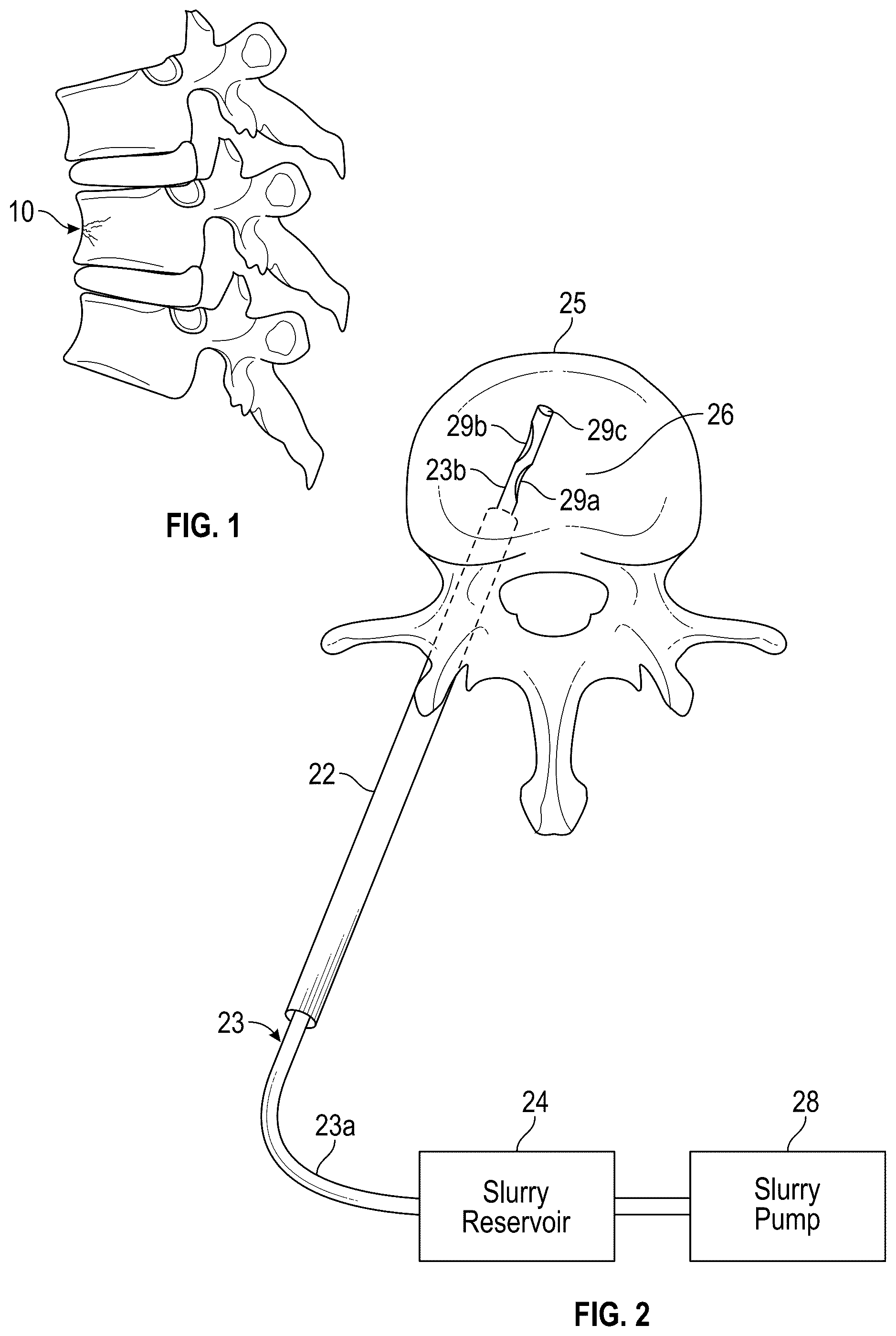 Patent US12102367 Figure 1 – Method, composition, and apparatus for stabilization of vertebral bodies