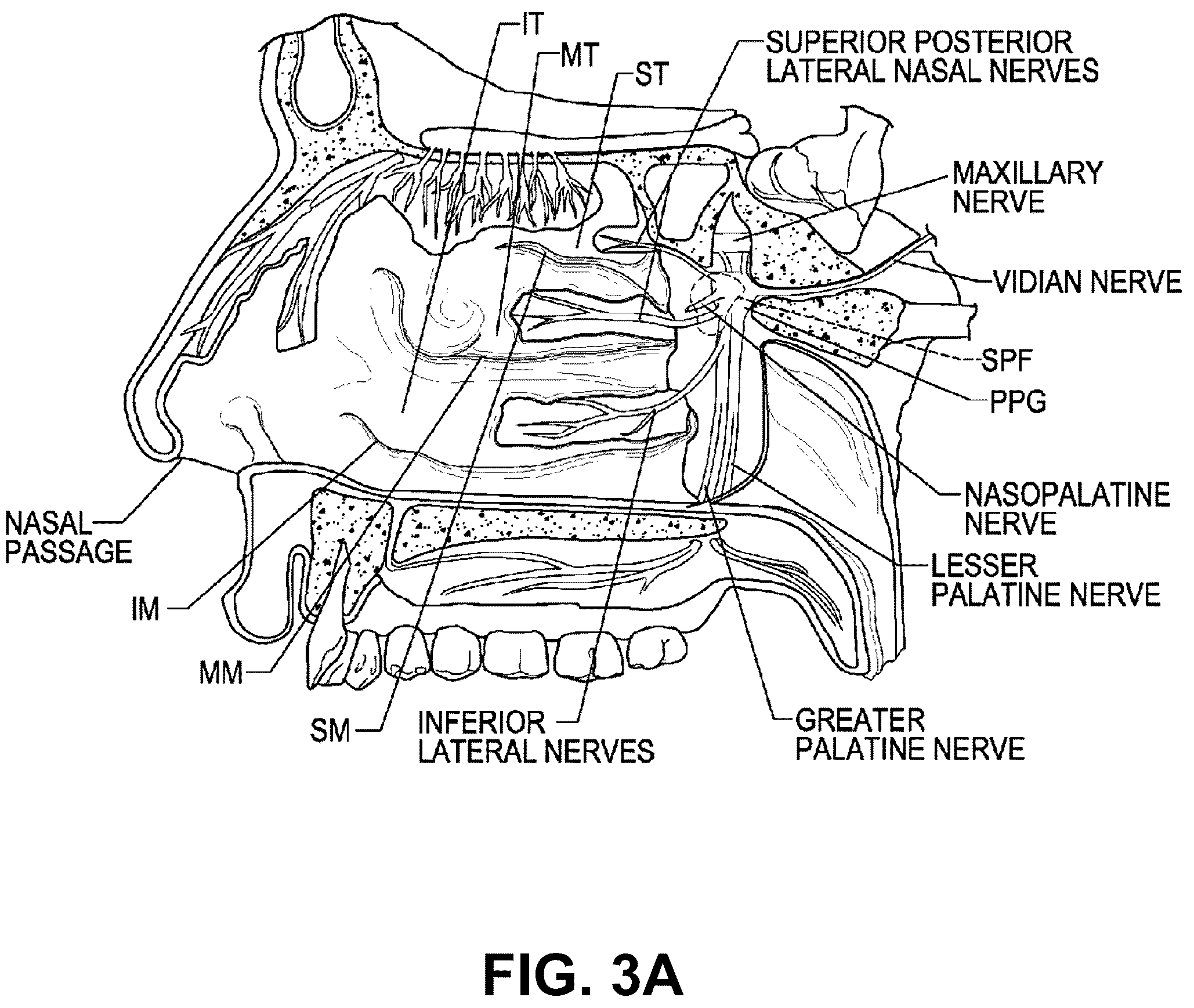 Patent US12102379 Figure 3 – Systems and methods for therapeutic nasal treatment using handheld device