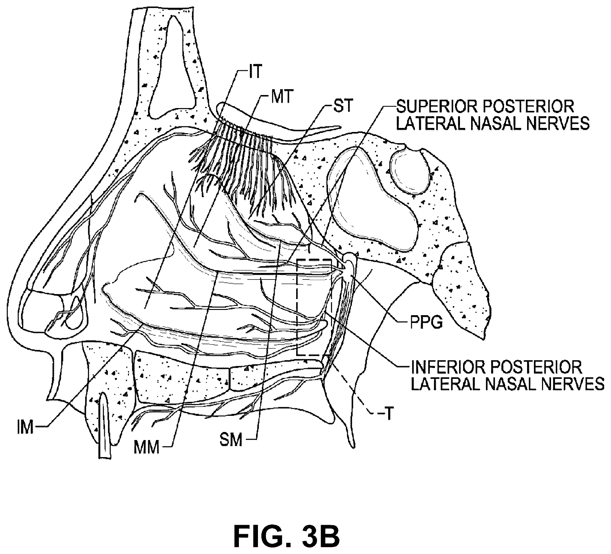 Patent US12102379 Figure 4 – Systems and methods for therapeutic nasal treatment using handheld device