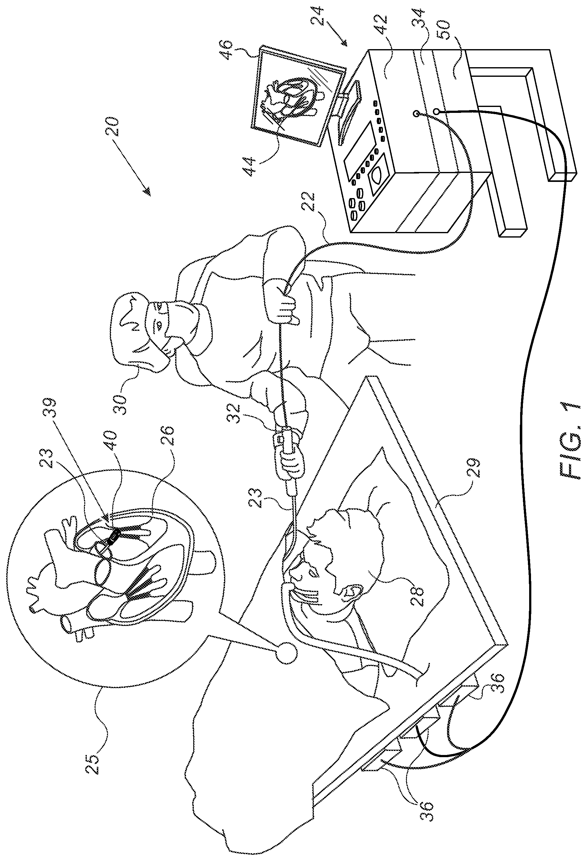Patent US12102381 — Focal ablation catheter incorporating a guidewire inserted through irrigation channel — Figure 1
