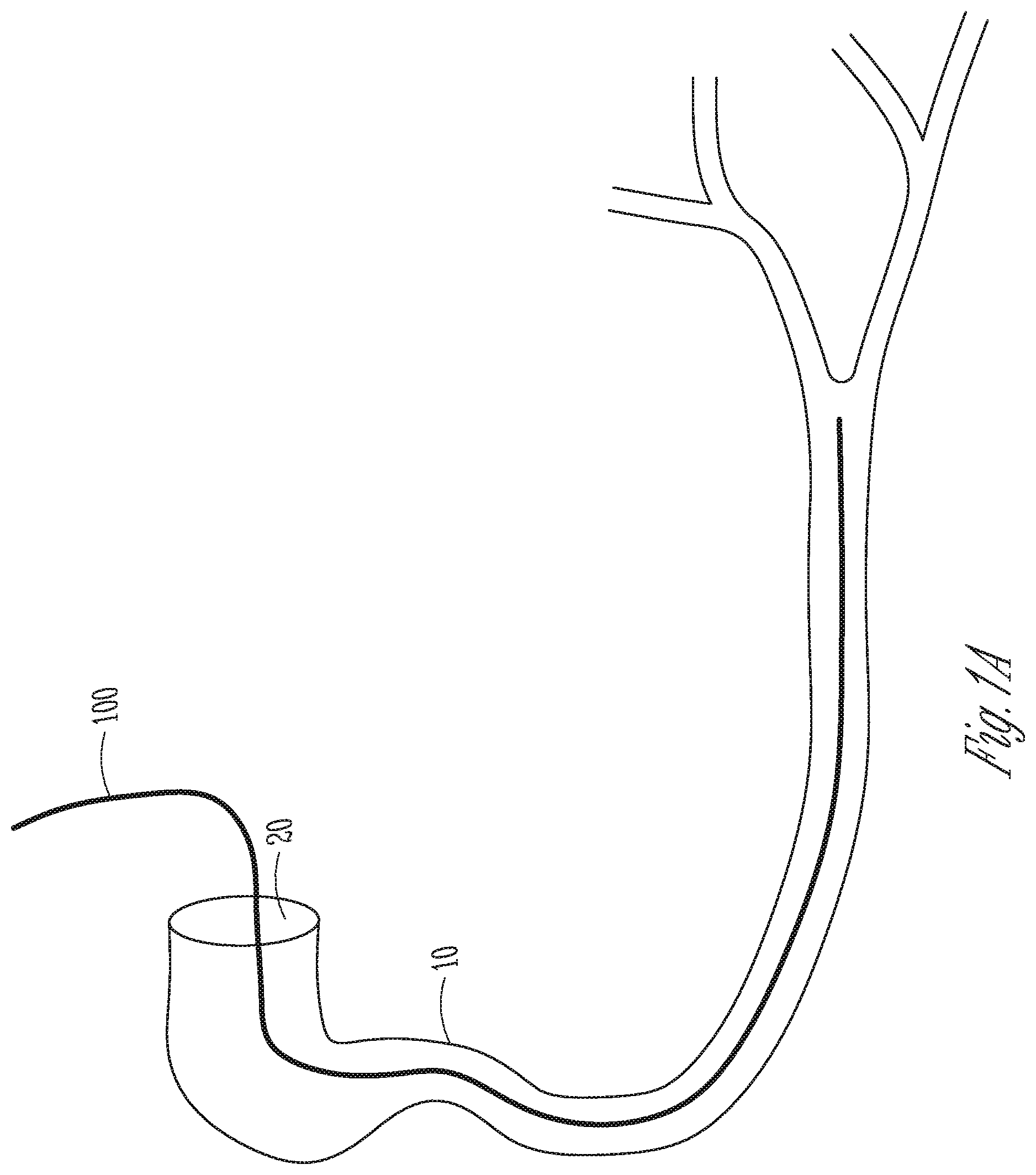 Patent US12102478 — User-attachable/detachable imaging catheter — Figure 1