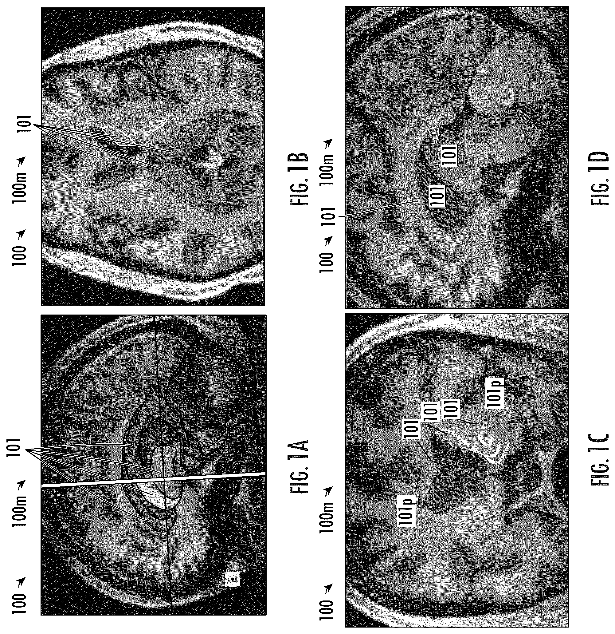 Patent US12102489 Figure 1 – Image-guided surgical systems with quantitative evaluation of in vivo thermal treatments and related methods