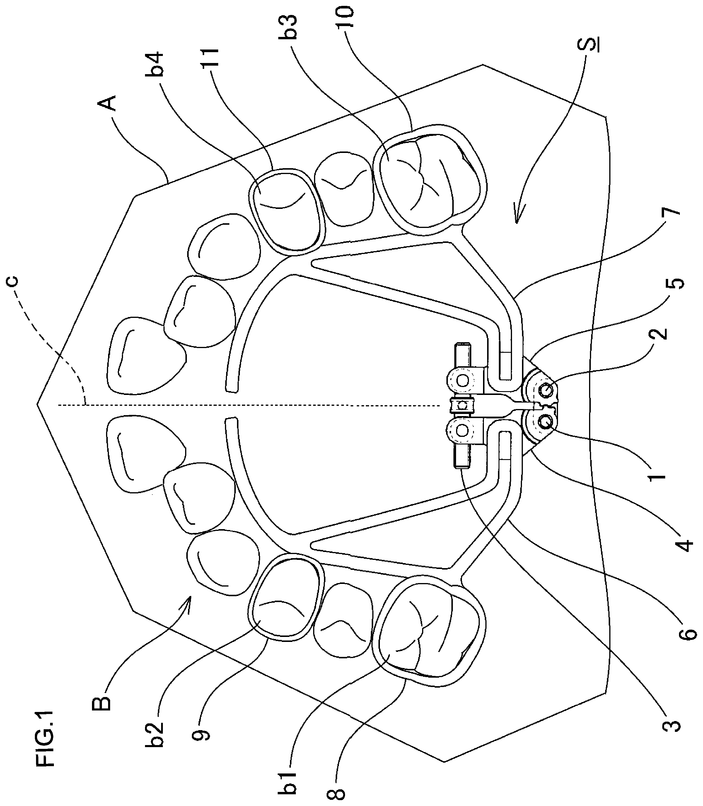 Patent US12102502 — Orthodontic expansion device — Figure 1