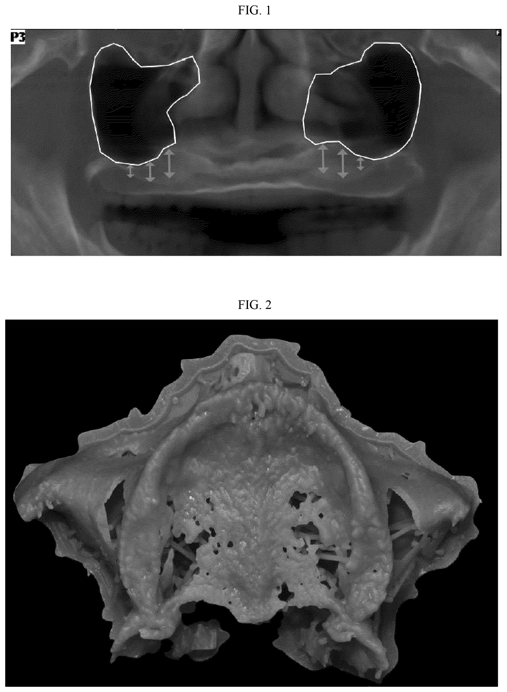 Patent US12102504 — Tooth implant method — Figure 1