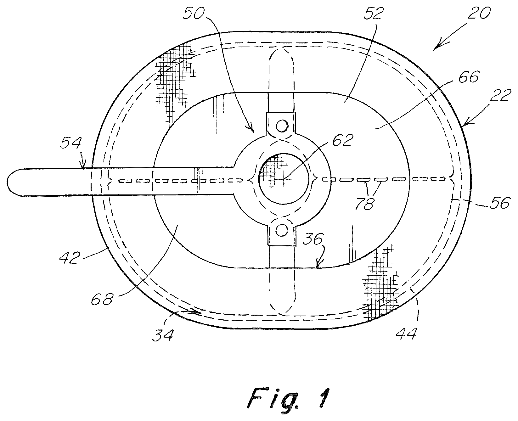 Patent US12102520 Figure 1 – Deployment device for a soft tissue repair prosthesis