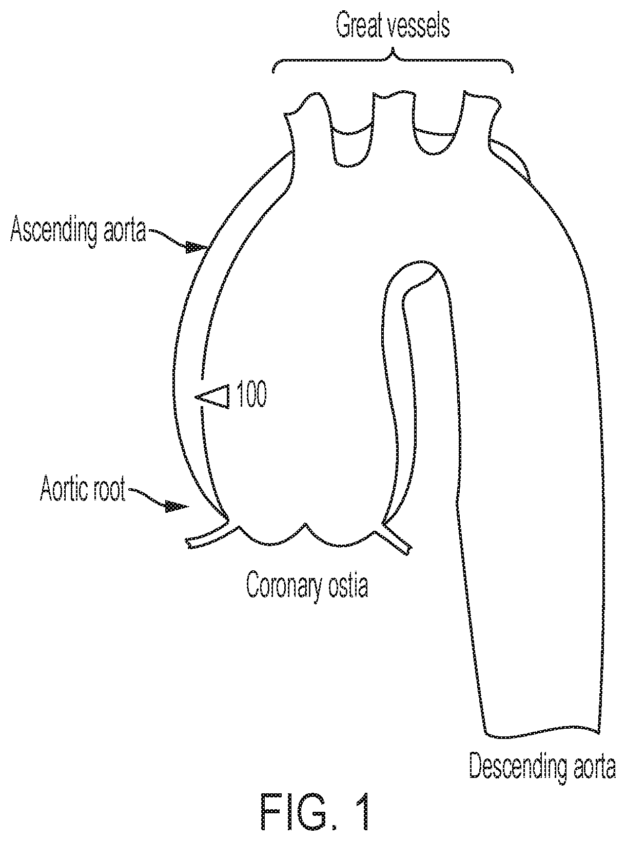 Patent US12102522 — Endovascular stent graft — Figure 1