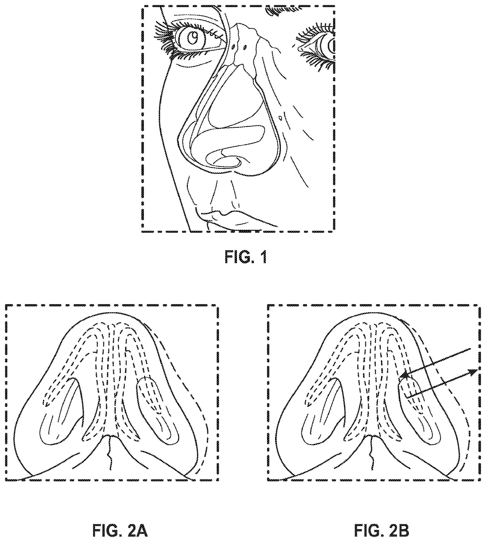 Patent US12102525 — Nasal implants, delivery tools, systems, and methods of use — Figure 1
