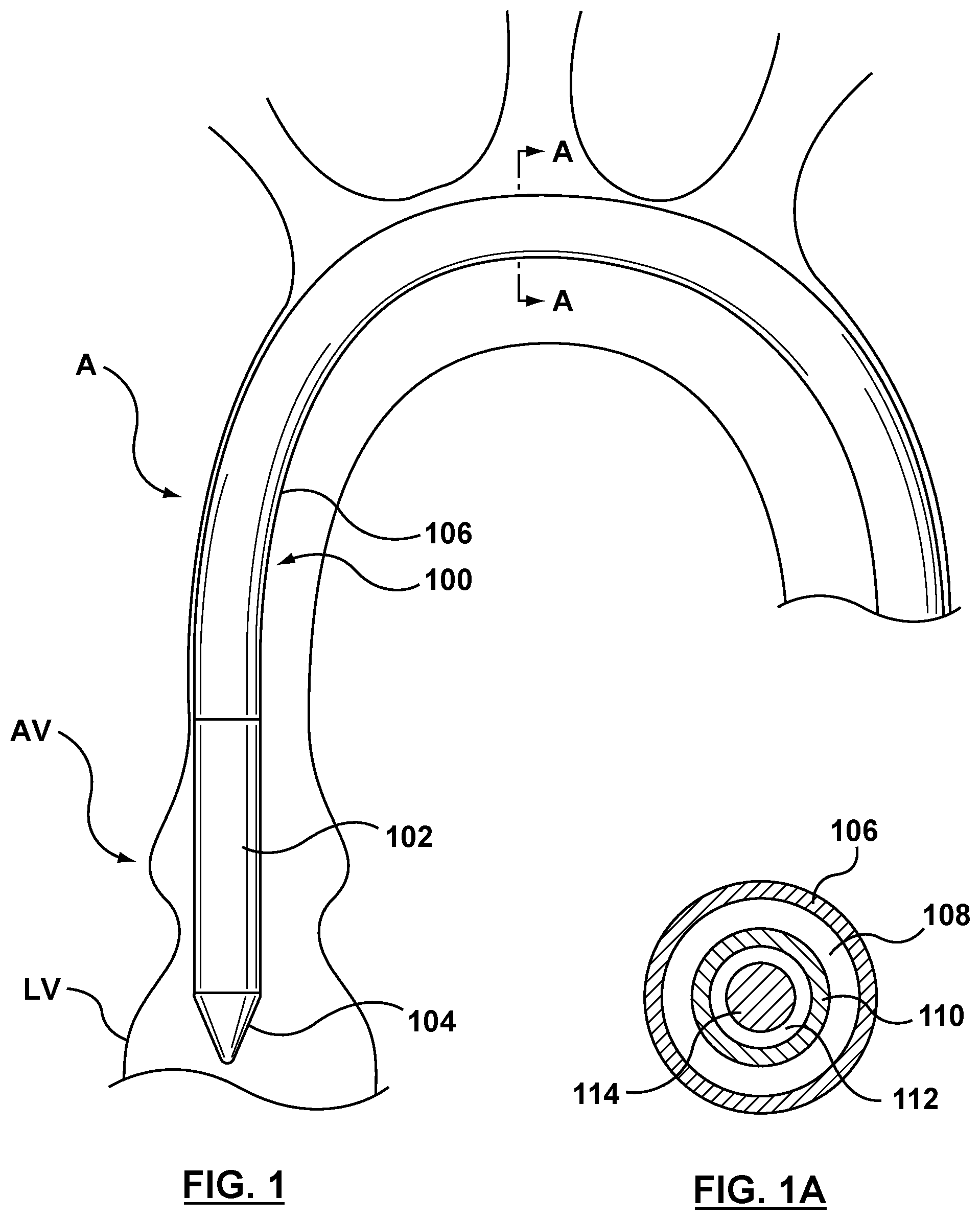 Patent US12102530 — Delivery system having an integral centering mechanism for positioning a valve prosthesis in situ — Figure 1