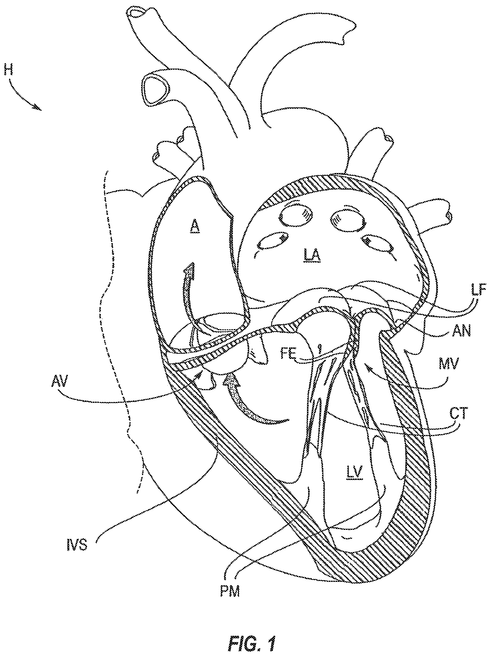 Patent US12102531 — Tissue cutting systems, devices and methods — Figure 1