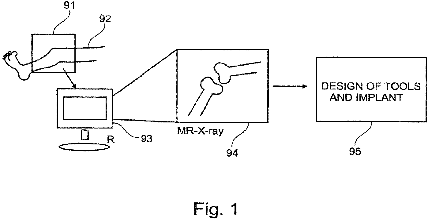 Patent US12102540 Figure 1 – System of designing a guide tool and/or surgical kit tools and/or an implant comprising a positioning mark