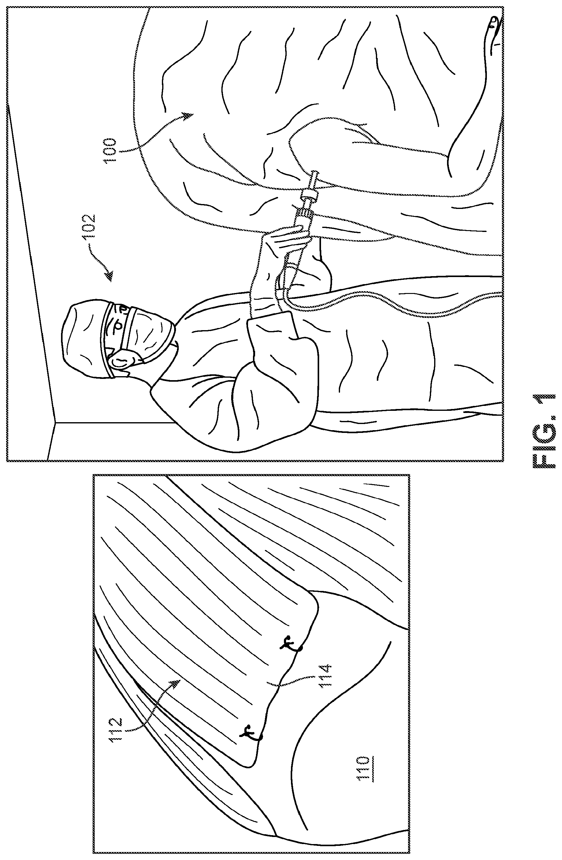 Patent US12102545 — Implant delivery device — Figure 1