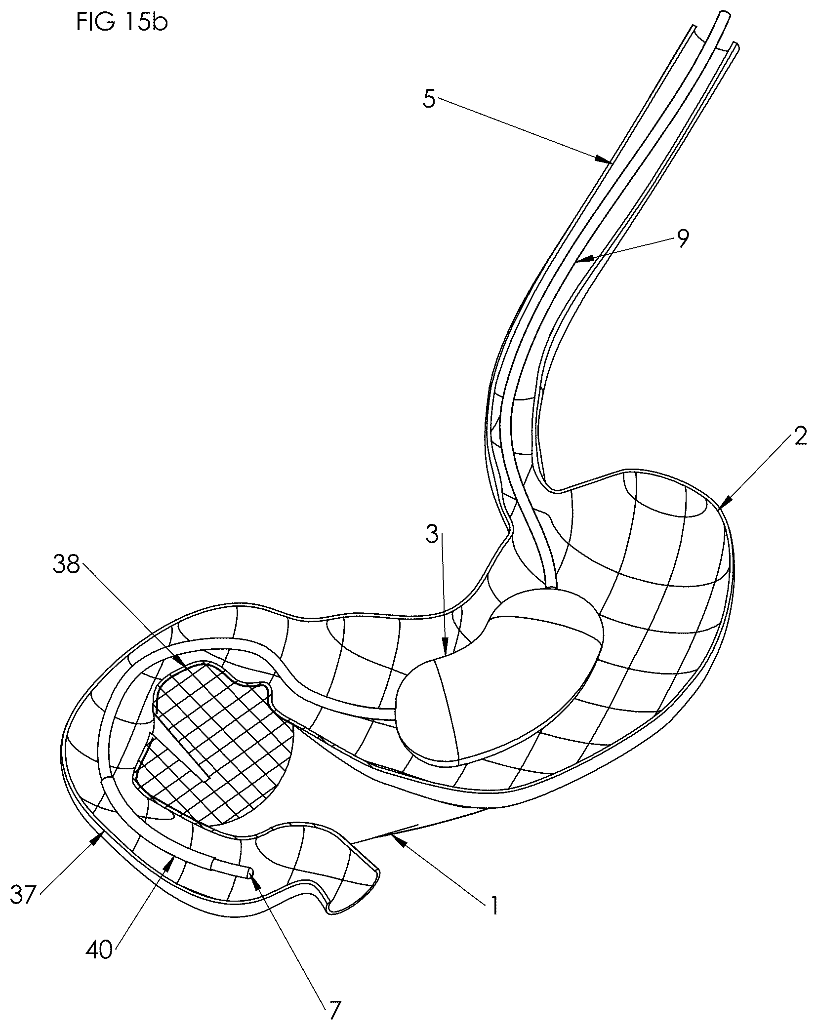 Patent US12102558 Figure 11 – Apparatus and method for cooling and/or heating an organ