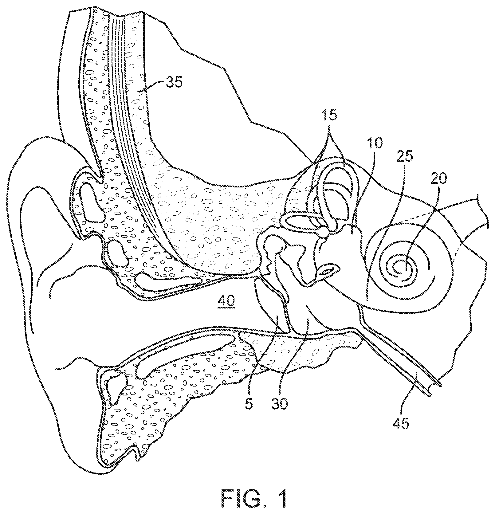 Patent US12102785 — Inner ear drug delivery devices and methods of use — Figure 1