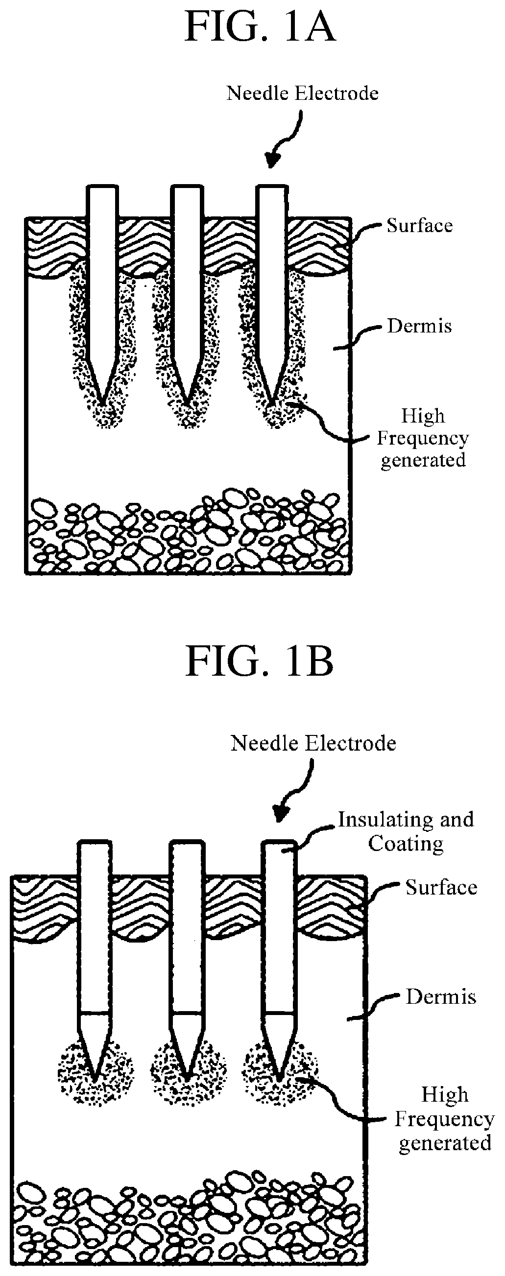Patent US12102811 — Medicine injecting tip, hand piece, and skin treating device — Figure 1