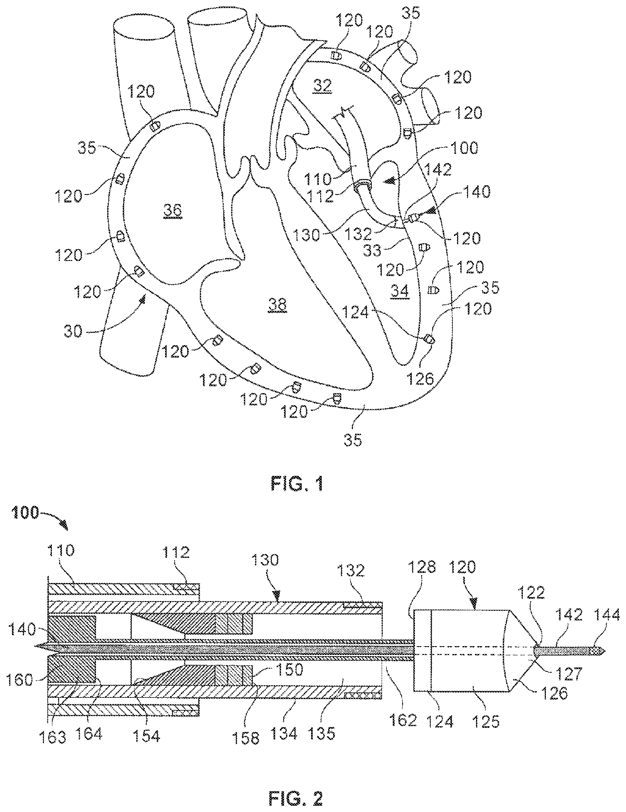 Patent US12102822 — Delivery of cardiac stimulation devices — Figure 1