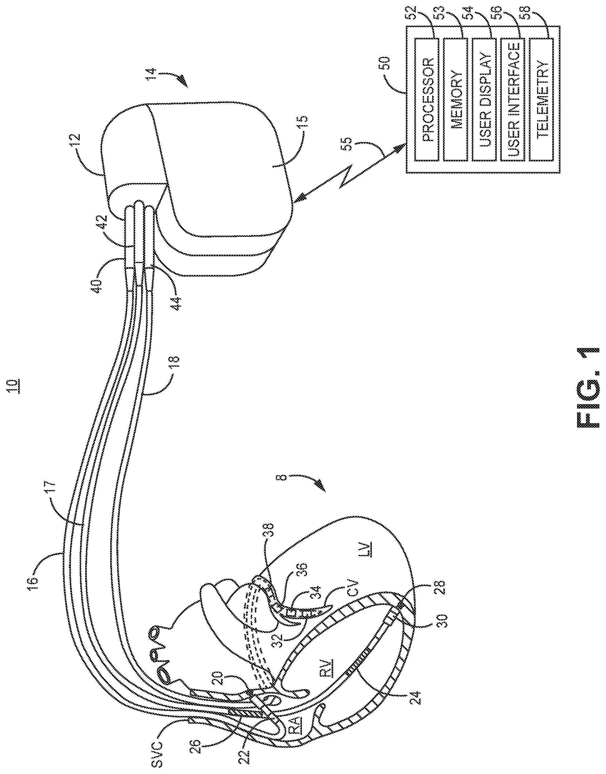 Patent US12102828 — T-wave morphology analysis for pathological event detection — Figure 1