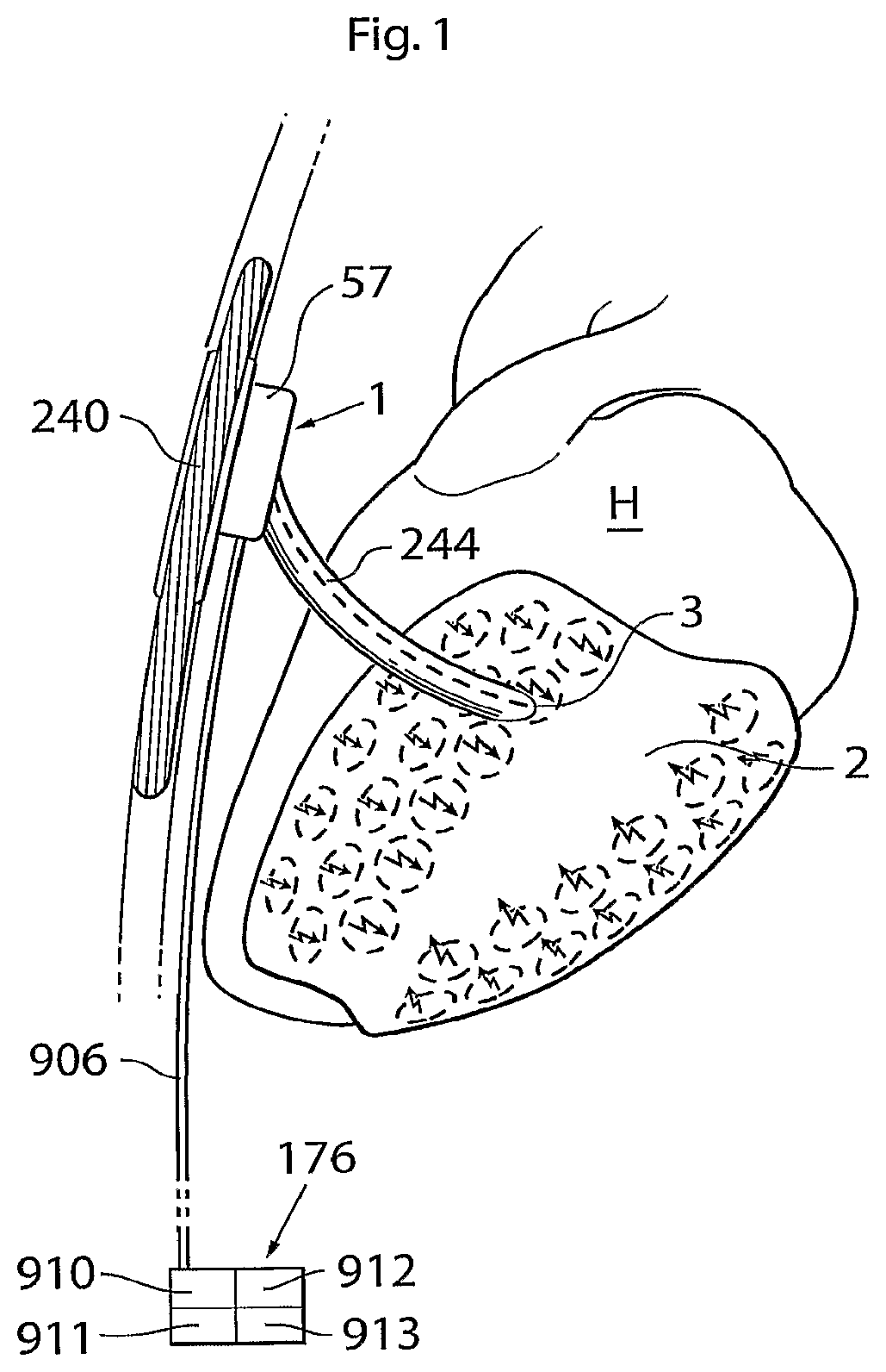 Patent US12102829 — Heart help device, method and system — Figure 1